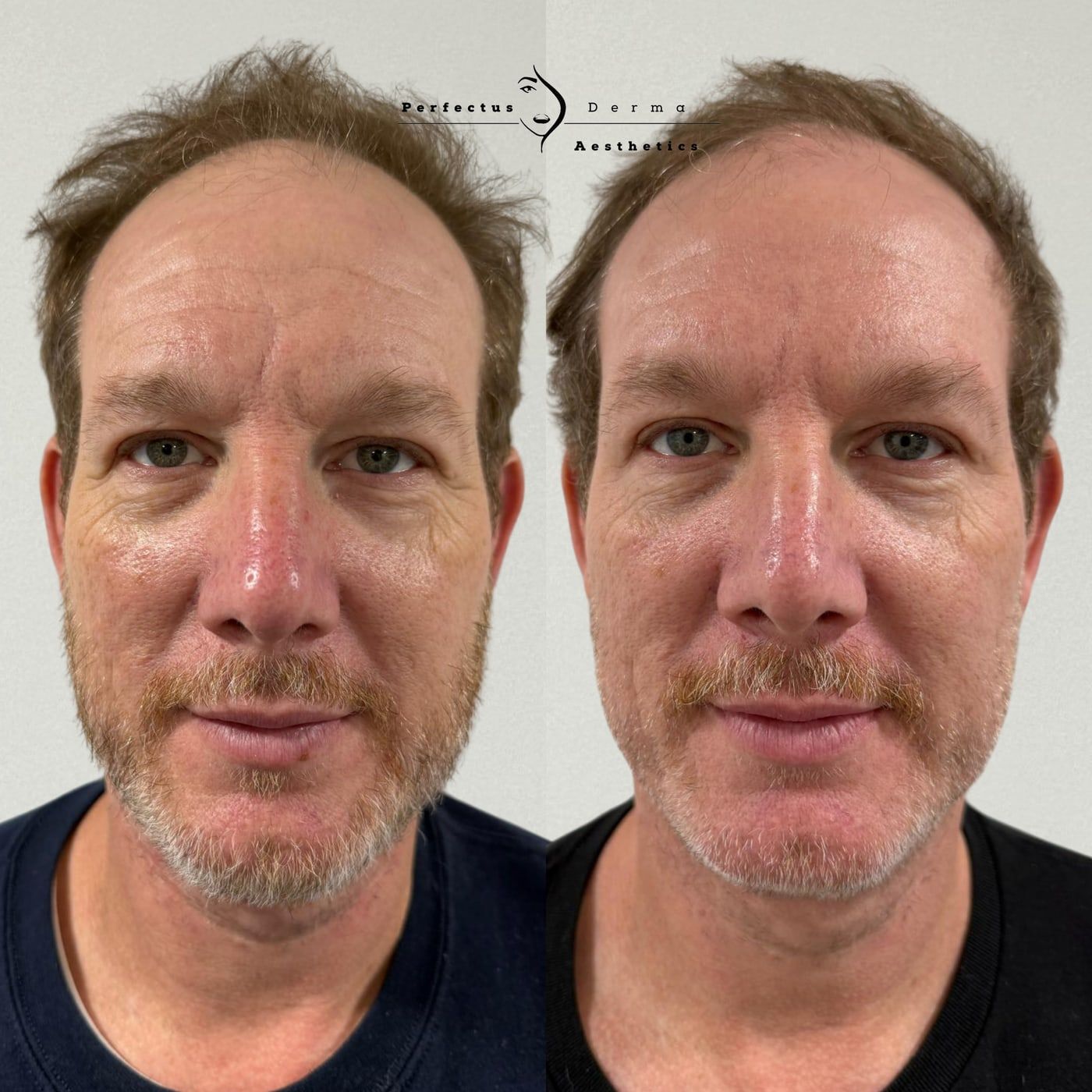 A patient before and after a combination plan of polynucleotides, Hydro2Facial and anti-wrinkle treatment at Perfectus Derma Aesthetics