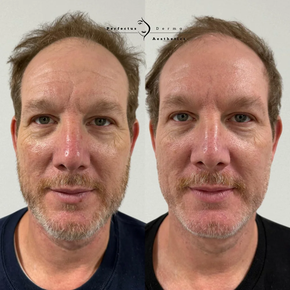 A patient before and after a combination plan of polynucleotides, Hydro2Facial and anti-wrinkle treatment at Perfectus Derma Aesthetics