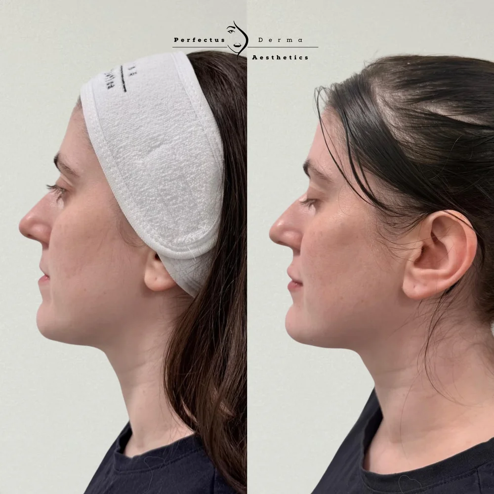 Cheeks, chin, jawline and lips in profile before and after dermal filler treatment at Perfectus Derma Aesthetics