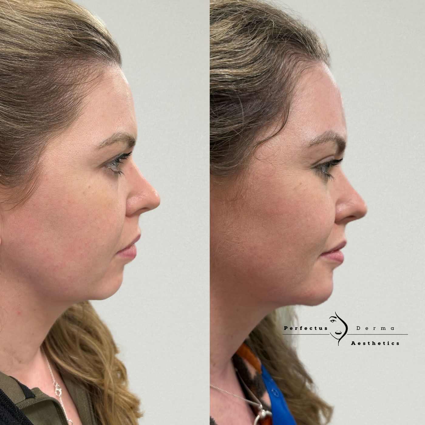 Chin, lips, jawline and cheeks in profile before and after dermal filler treatment at Perfectus Derma Aesthetics