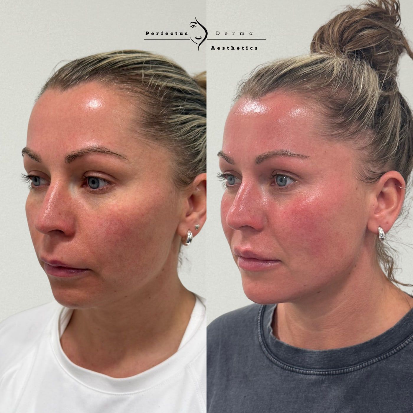 Mid and lower face before and after dermal filler contouring at Perfectus Derma Aesthetics