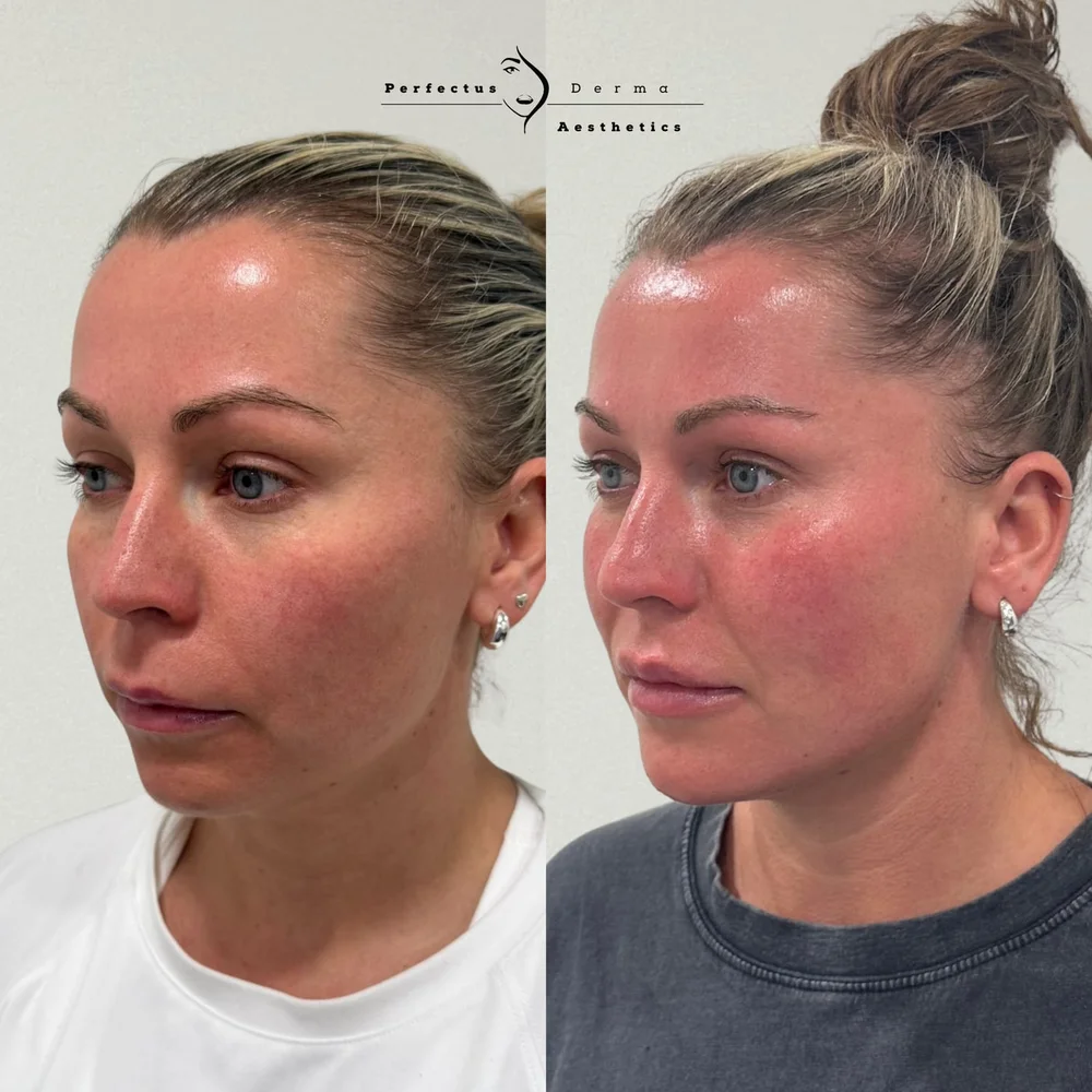 Mid and lower face before and after dermal filler contouring at Perfectus Derma Aesthetics