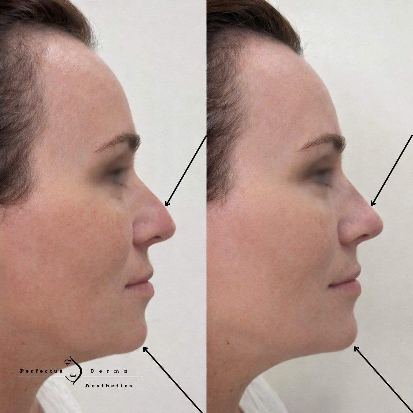 Nose in profile before and after non-surgical rhinoplasty with dermal filler at Perfectus Derma Aesthetics