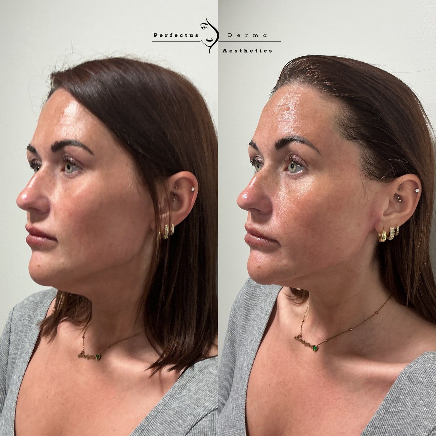 Facial skin in profile before and after a Hydro2Facial at Perfectus Derma Aesthetics