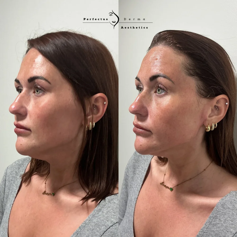 Facial skin in profile before and after a Hydro2Facial at Perfectus Derma Aesthetics