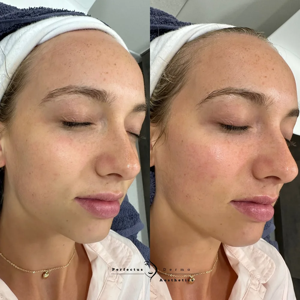 Facial skin before and after a Hydro2Facial at Perfectus Derma Aesthetics