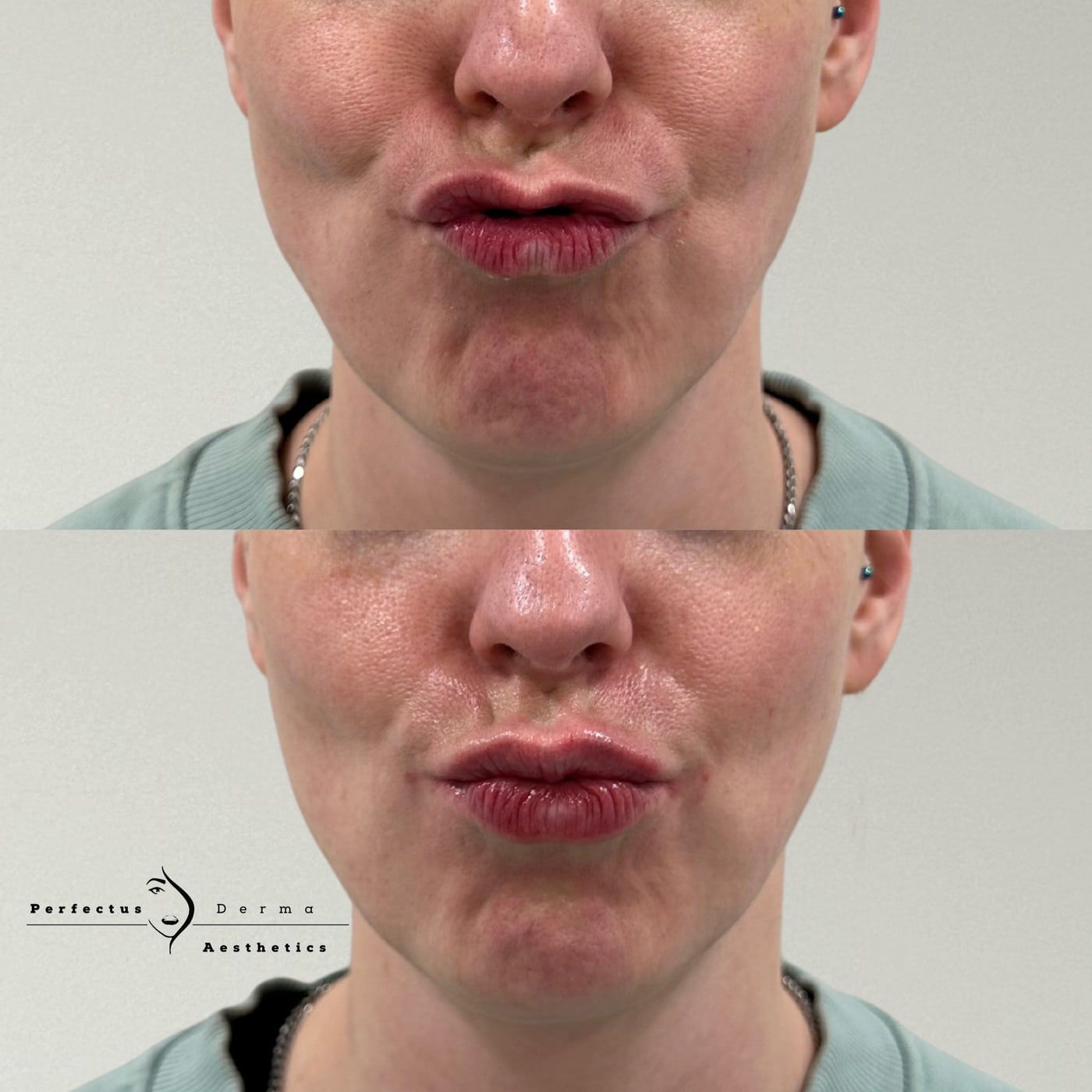 Lips before and after lip filler treatment at Perfectus Derma Aesthetics