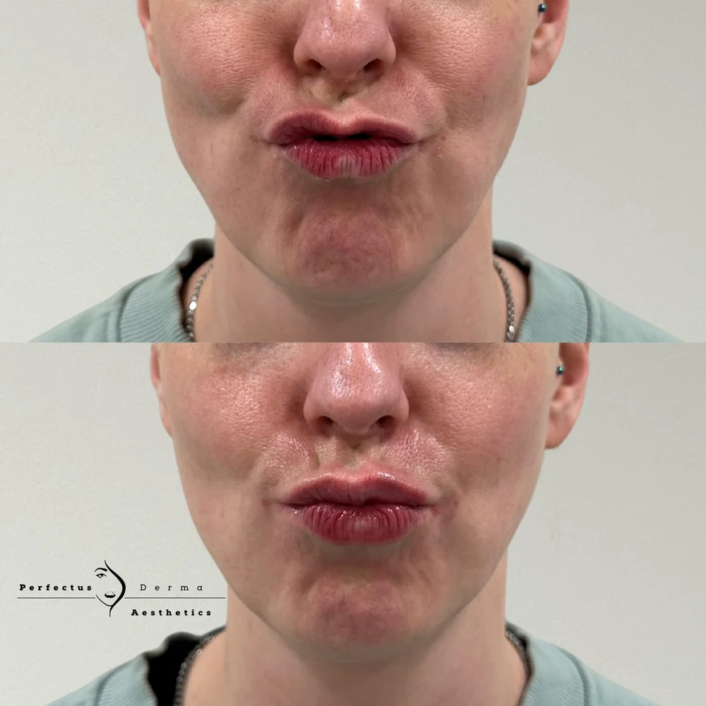 Lips before and after lip filler treatment at Perfectus Derma Aesthetics