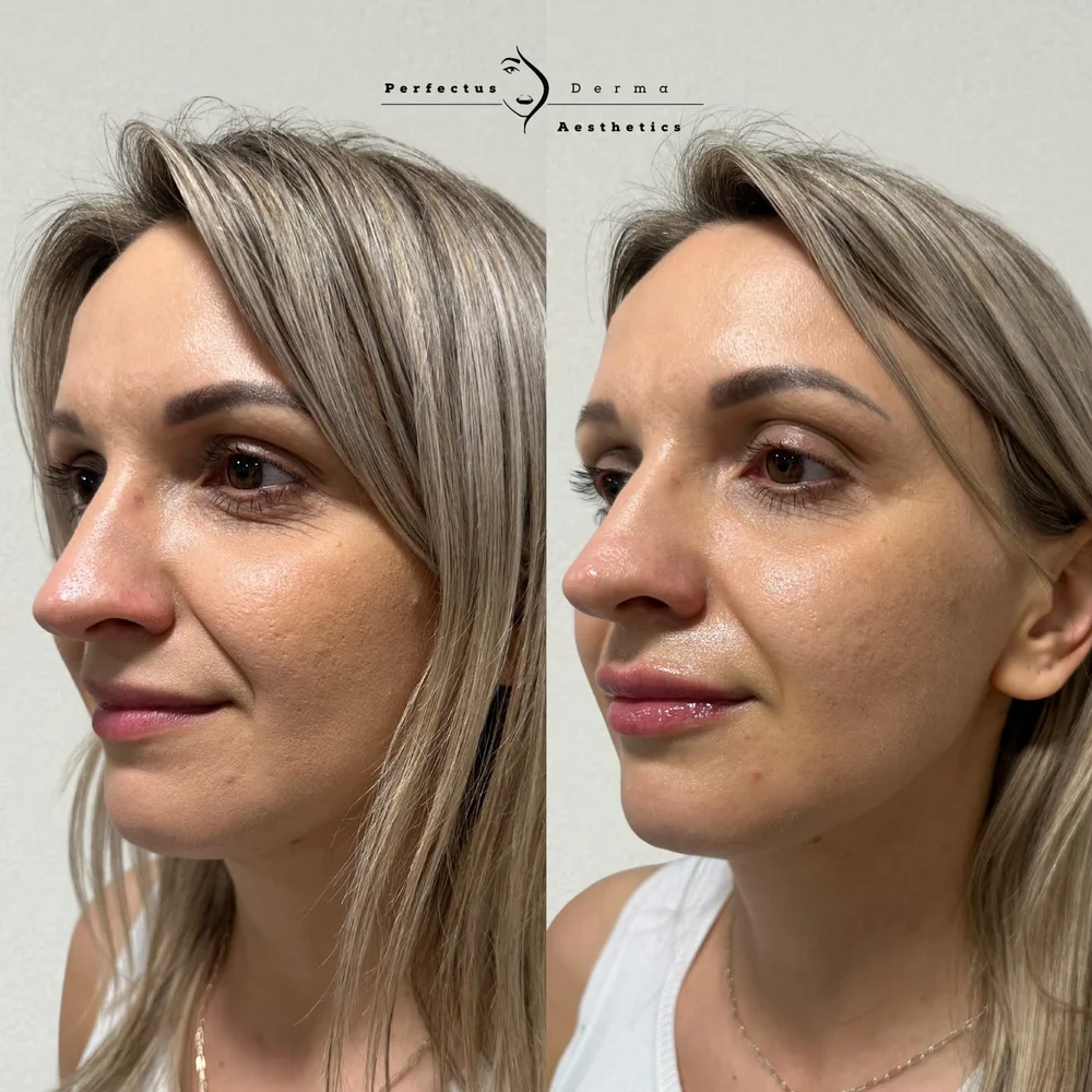 A patient before and after lip filler treatment at Perfectus Derma Aesthetics