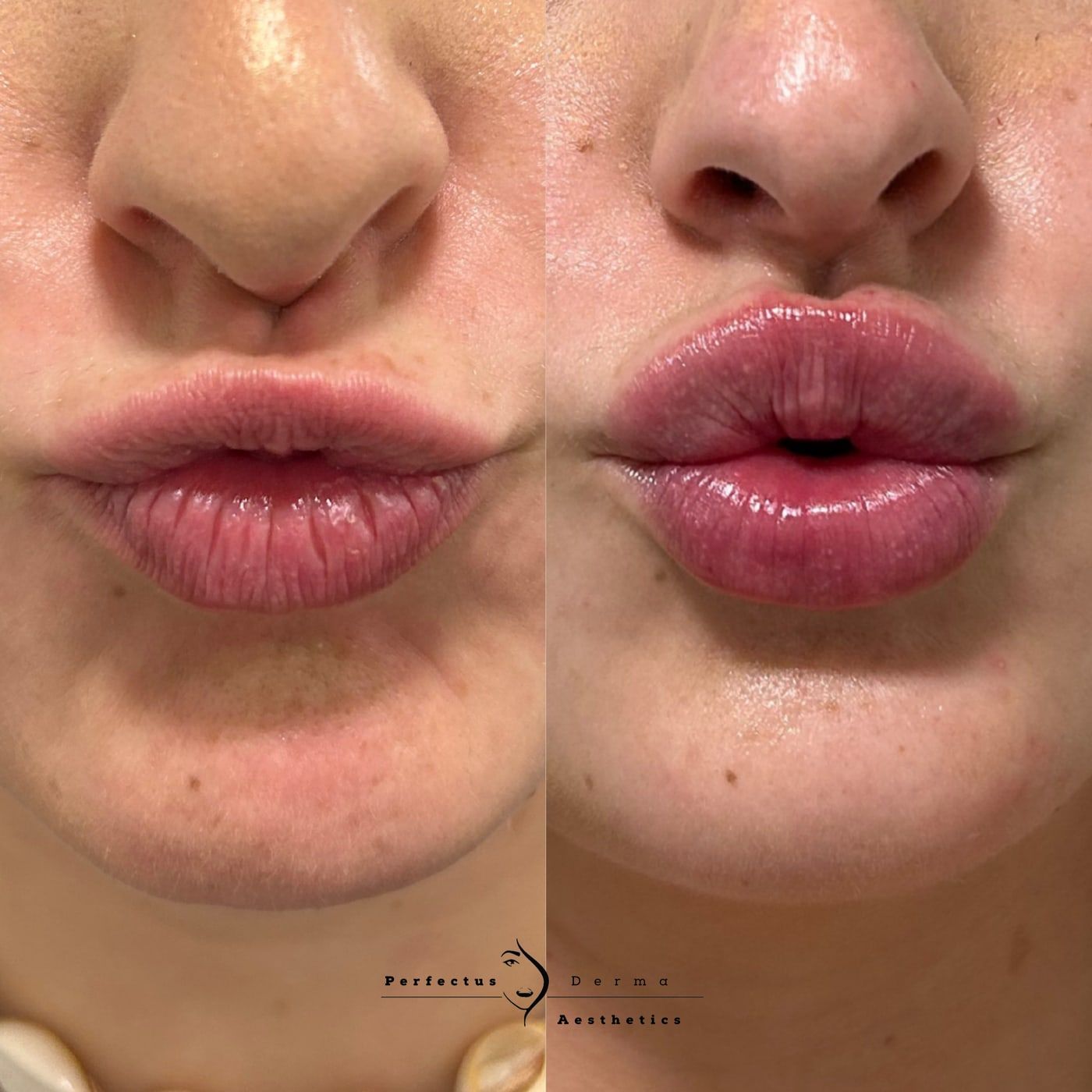 Lips in close-up before and after lip filler treatment at Perfectus Derma Aesthetics
