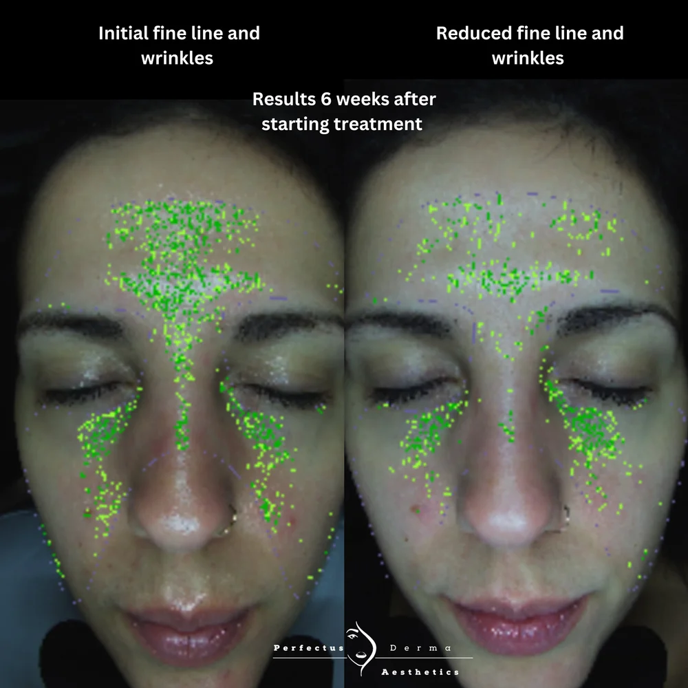 MEICET MC10 skin analysis scans showing fine lines and wrinkles before and six weeks after starting treatment at Perfectus Derma Aesthetics