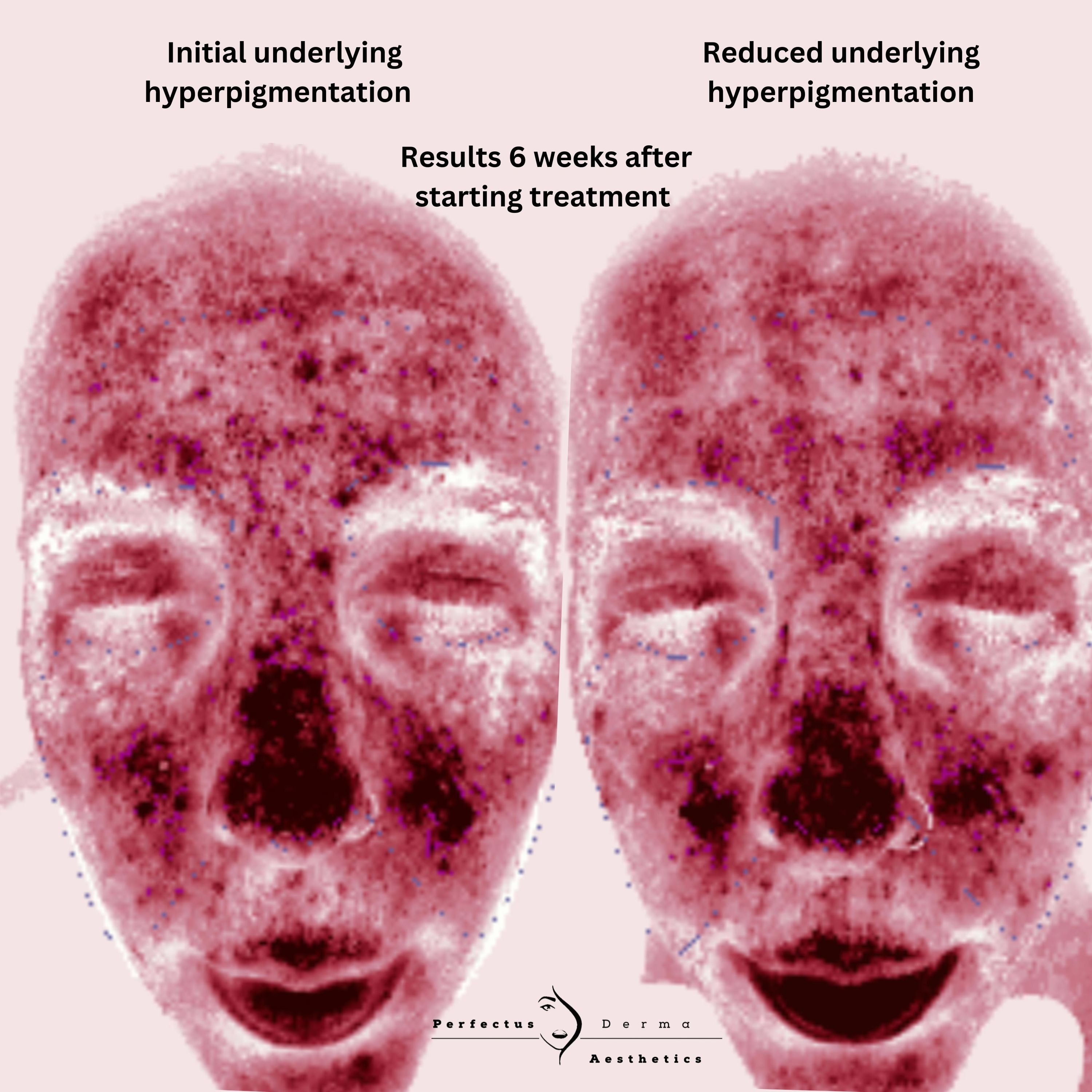 MEICET MC10 skin analysis scans showing underlying hyperpigmentation before and six weeks after starting treatment at Perfectus Derma Aesthetics