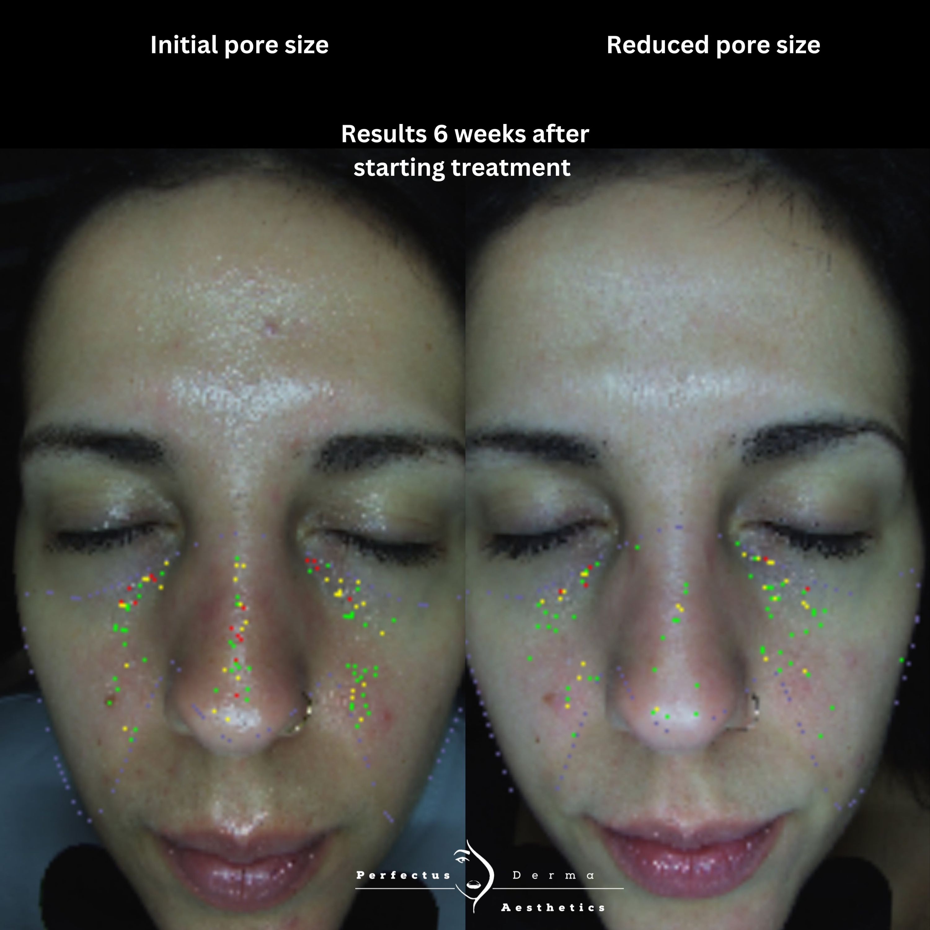 MEICET MC10 skin analysis scans showing pore size before and six weeks after starting treatment at Perfectus Derma Aesthetics