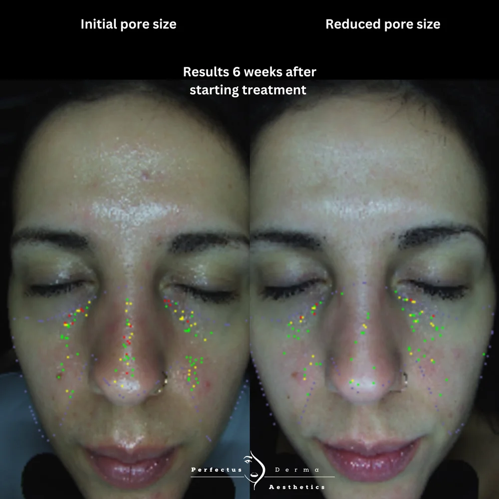 MEICET MC10 skin analysis scans showing pore size before and six weeks after starting treatment at Perfectus Derma Aesthetics