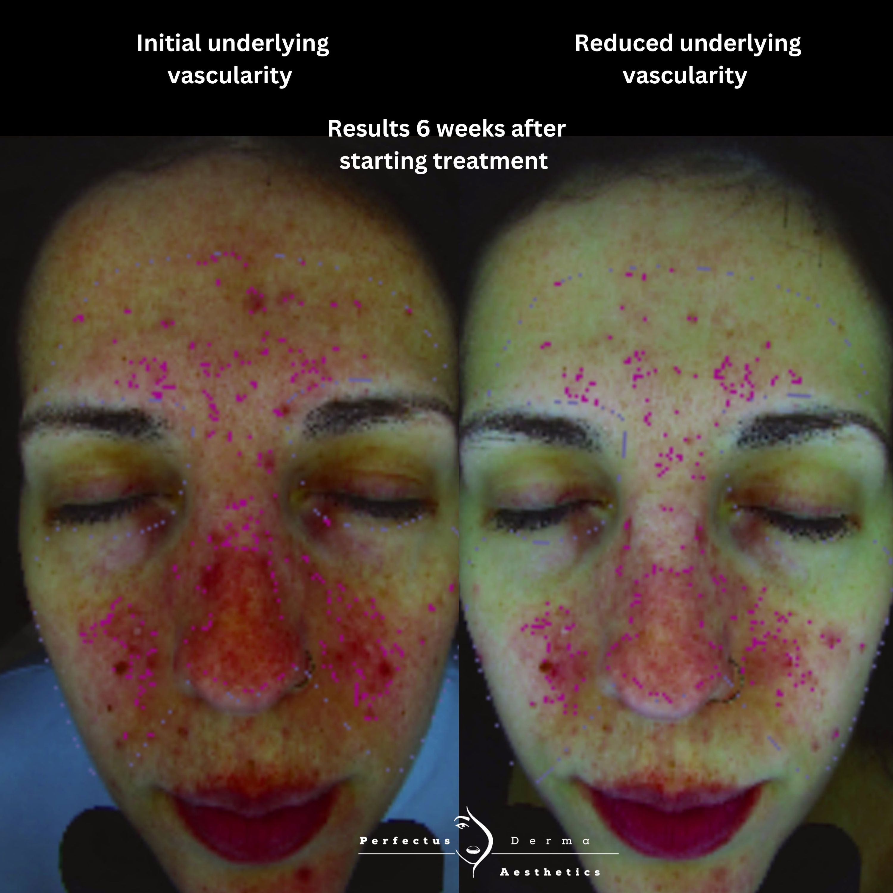 MEICET MC10 skin analysis scans showing underlying vascularity before and six weeks after starting treatment at Perfectus Derma Aesthetics