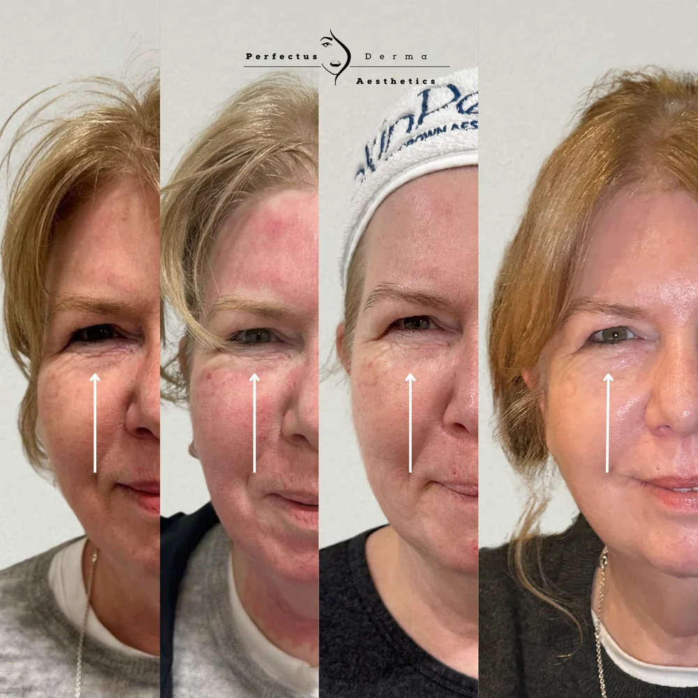 Cheek and under-eye area across four stages of a combination of polynucleotides and SkinPen microneedling at Perfectus Derma Aesthetics
