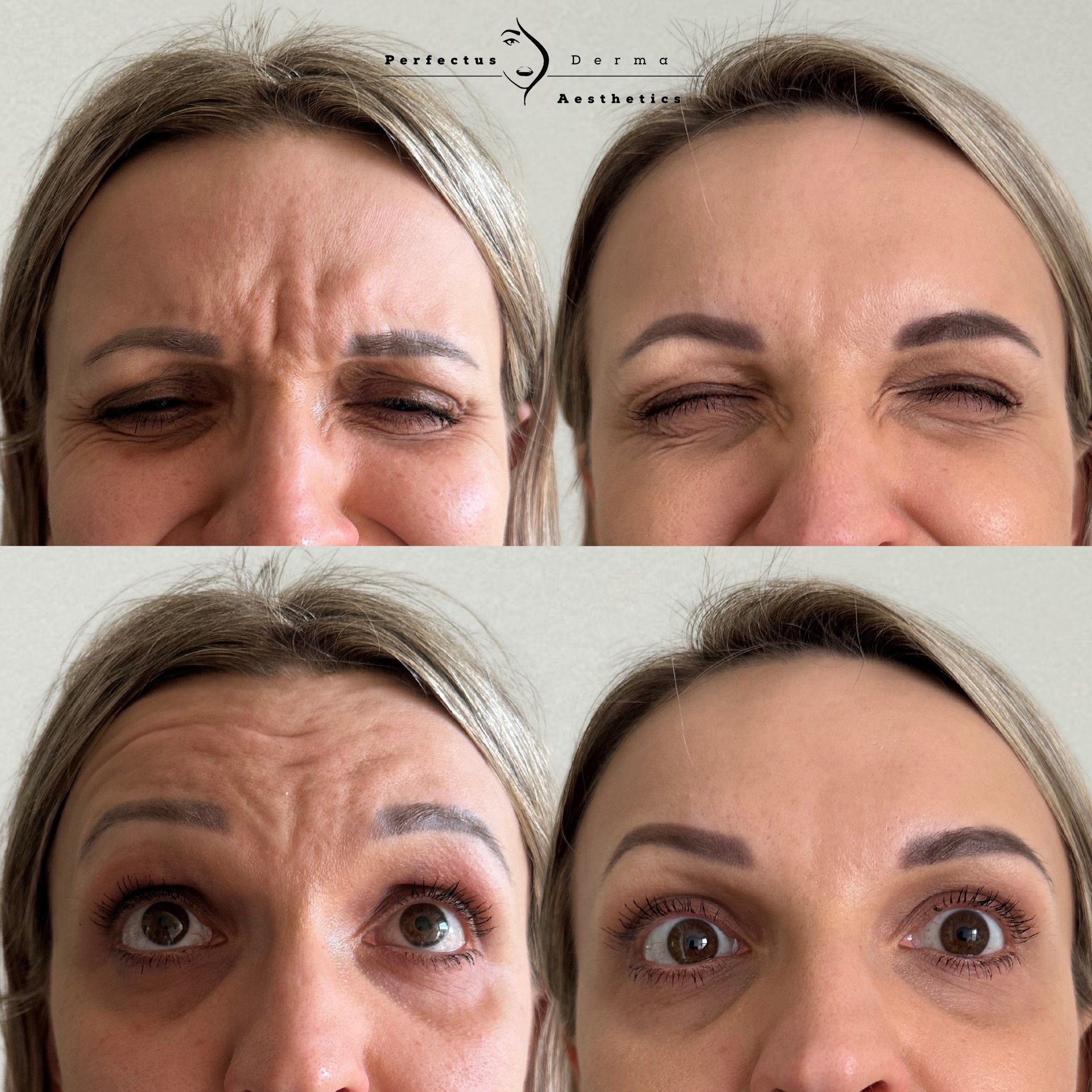 A patient frowning and raising the brows, before and two weeks after anti-wrinkle treatment at Perfectus Derma Aesthetics
