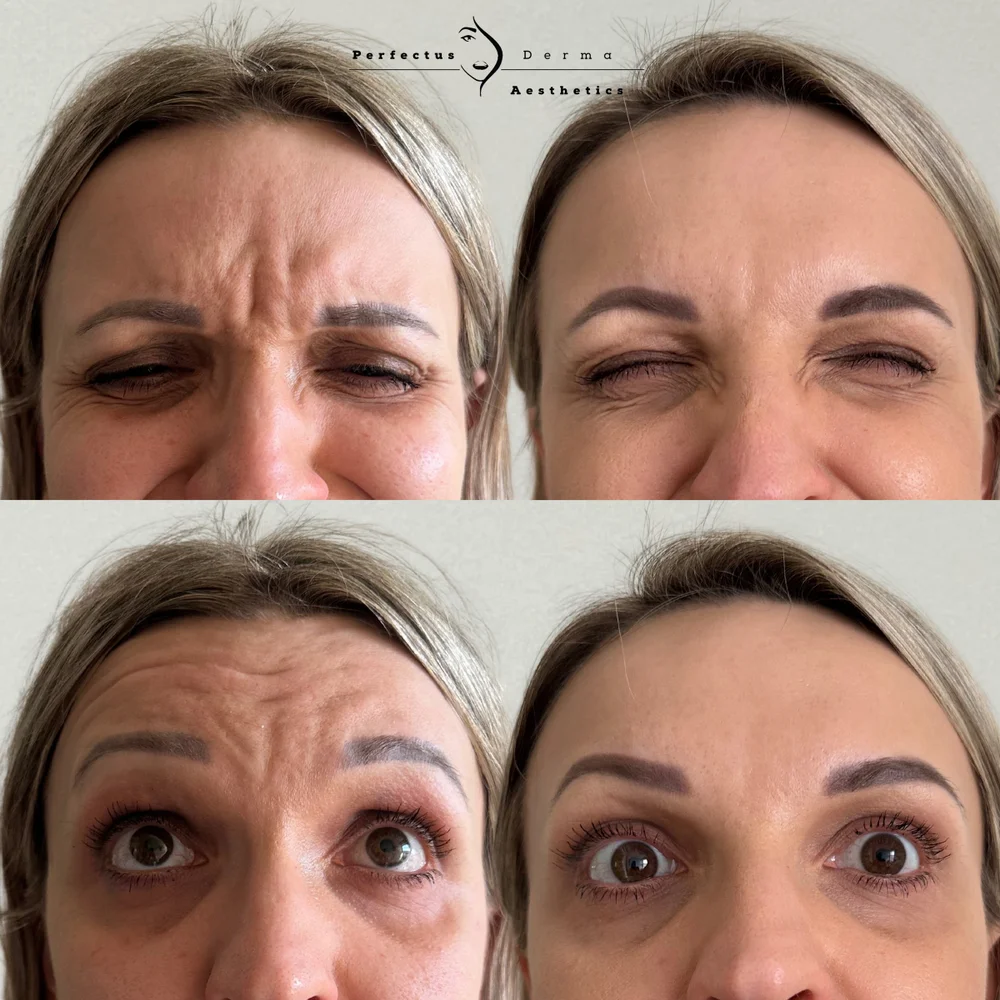 A patient frowning and raising the brows, before and two weeks after anti-wrinkle treatment at Perfectus Derma Aesthetics