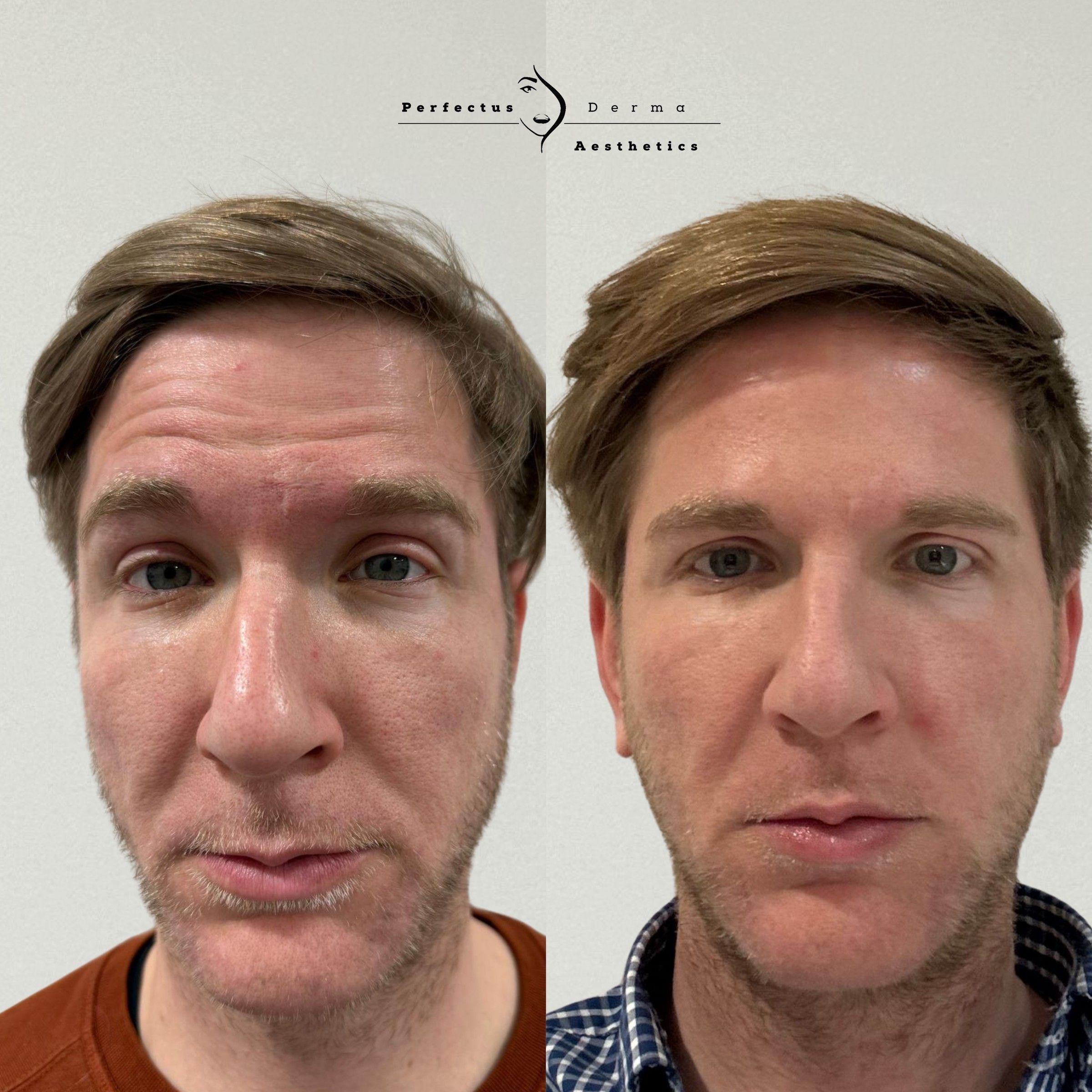 Forehead lines before and two weeks after anti-wrinkle treatment at Perfectus Derma Aesthetics