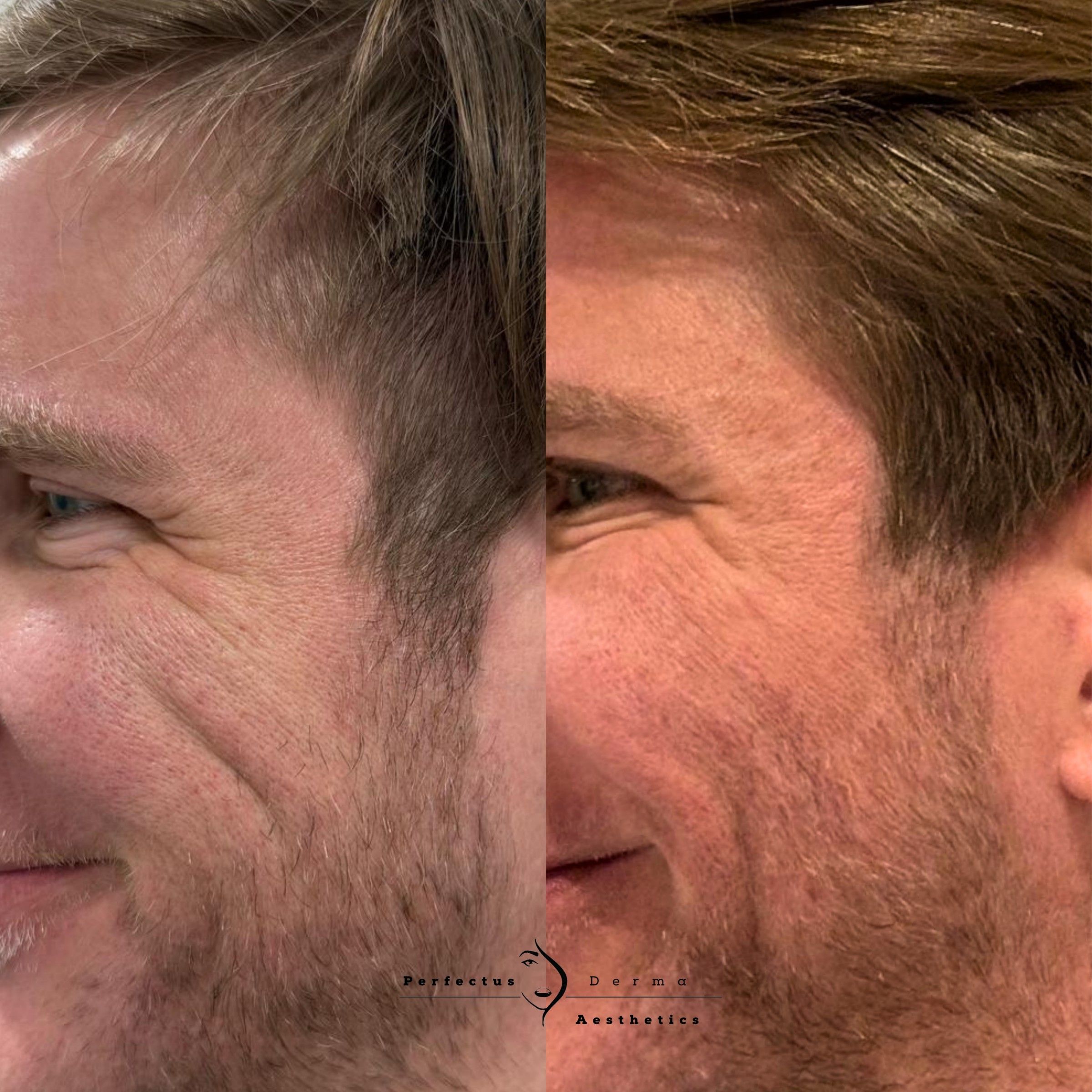 Lines around the eyes before and two weeks after anti-wrinkle treatment at Perfectus Derma Aesthetics