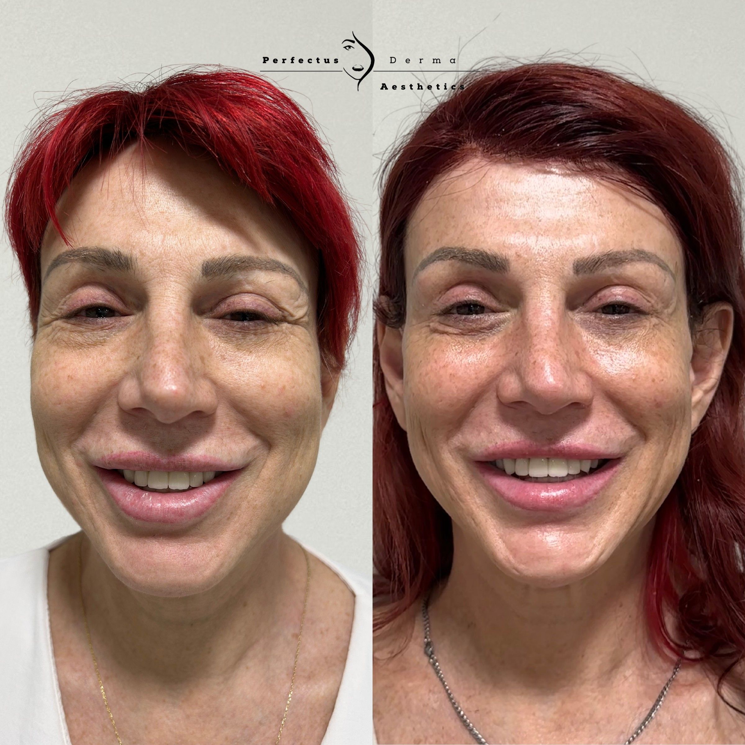 Front view before and after eighteen months of a bespoke facial feminisation plan at Perfectus Derma Aesthetics