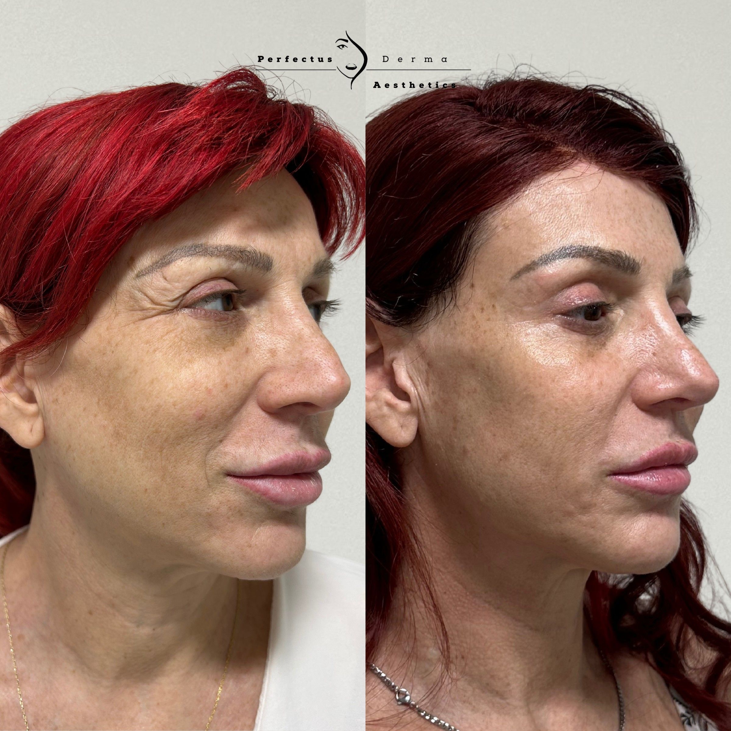 Three-quarter view before and after eighteen months of a bespoke facial feminisation plan at Perfectus Derma Aesthetics