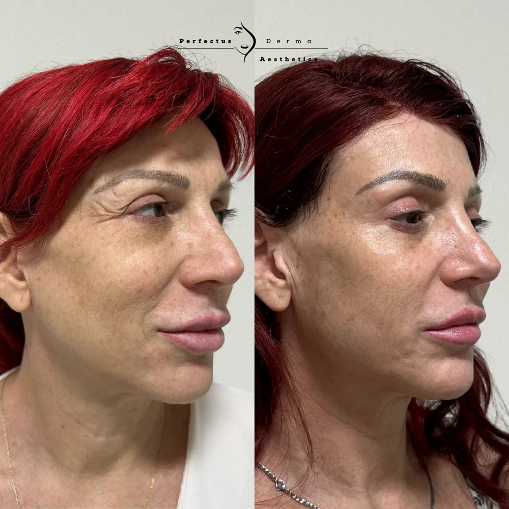 Three-quarter view before and after eighteen months of a bespoke facial feminisation plan at Perfectus Derma Aesthetics
