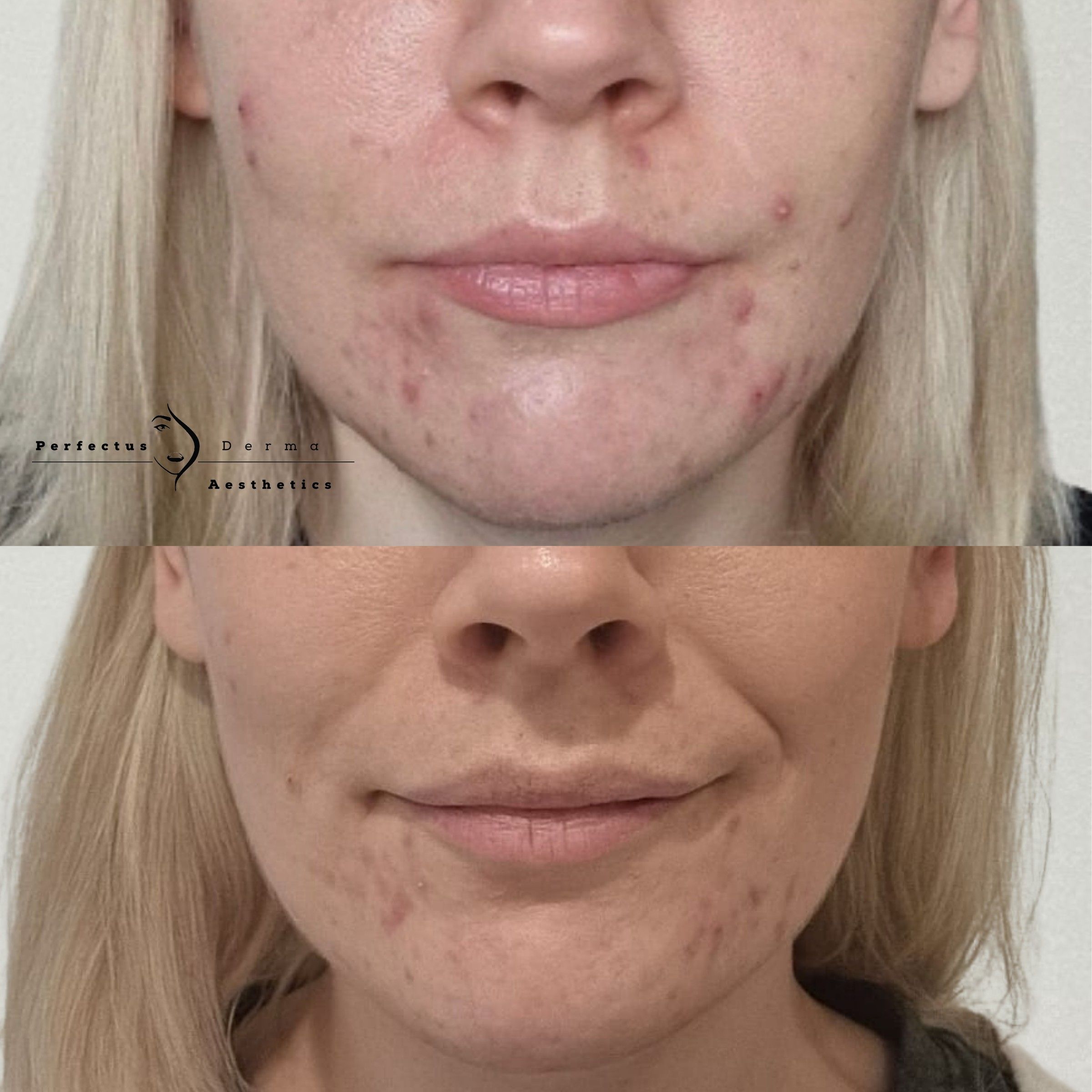Acne-prone skin before and after a science-based skincare protocol at Perfectus Derma Aesthetics