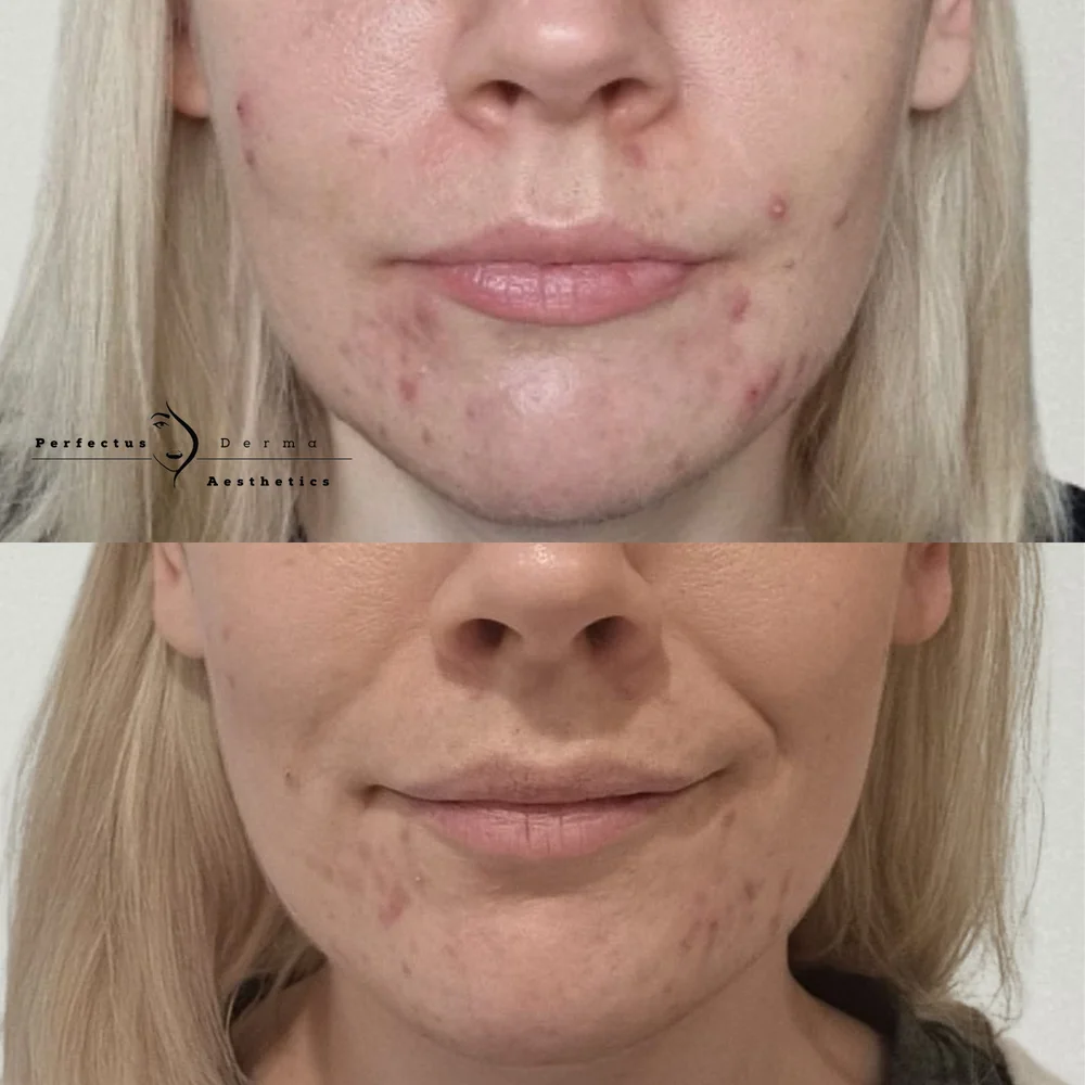 Acne-prone skin before and after a science-based skincare protocol at Perfectus Derma Aesthetics