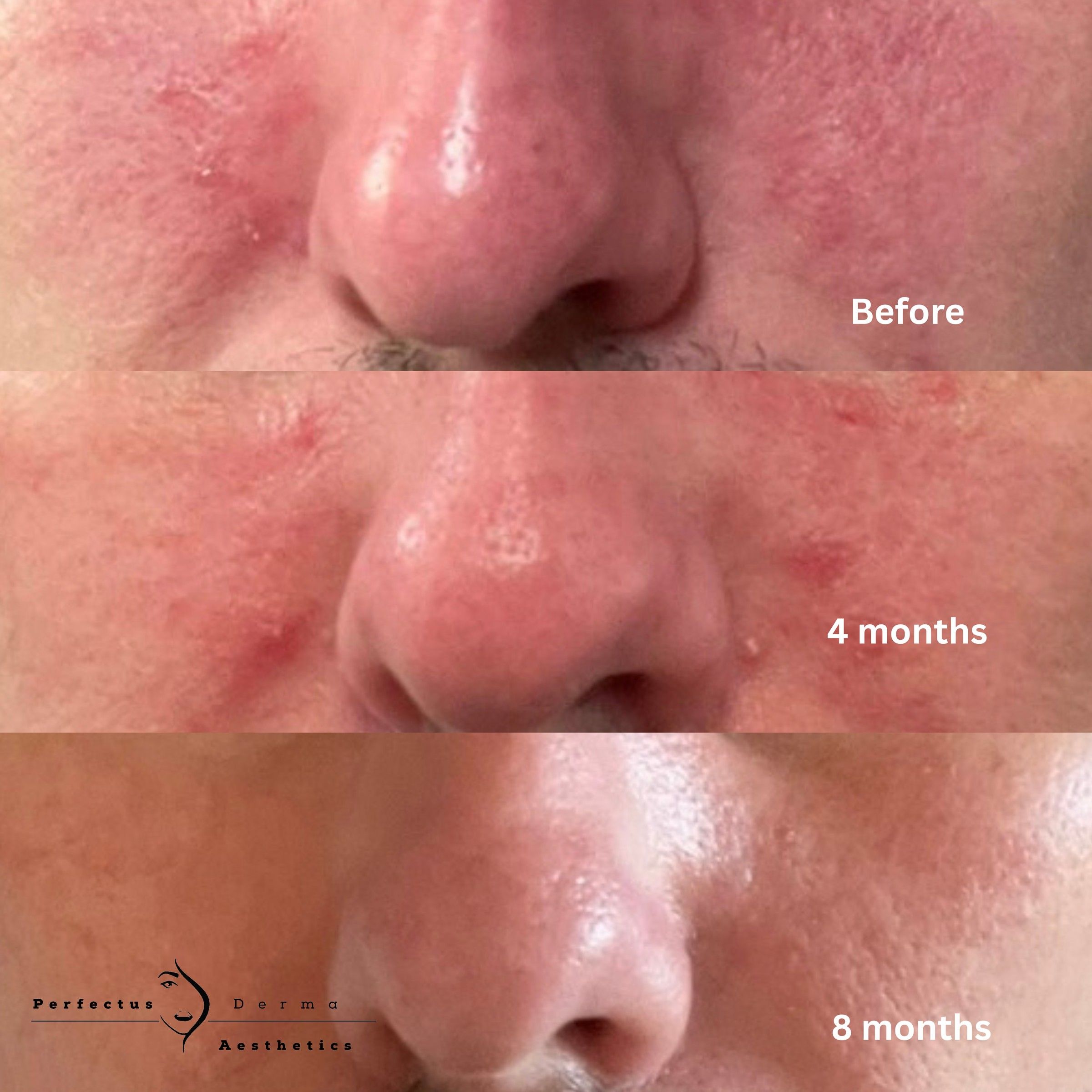 Rosacea-prone skin before, four months and eight months into a science-based skincare protocol at Perfectus Derma Aesthetics