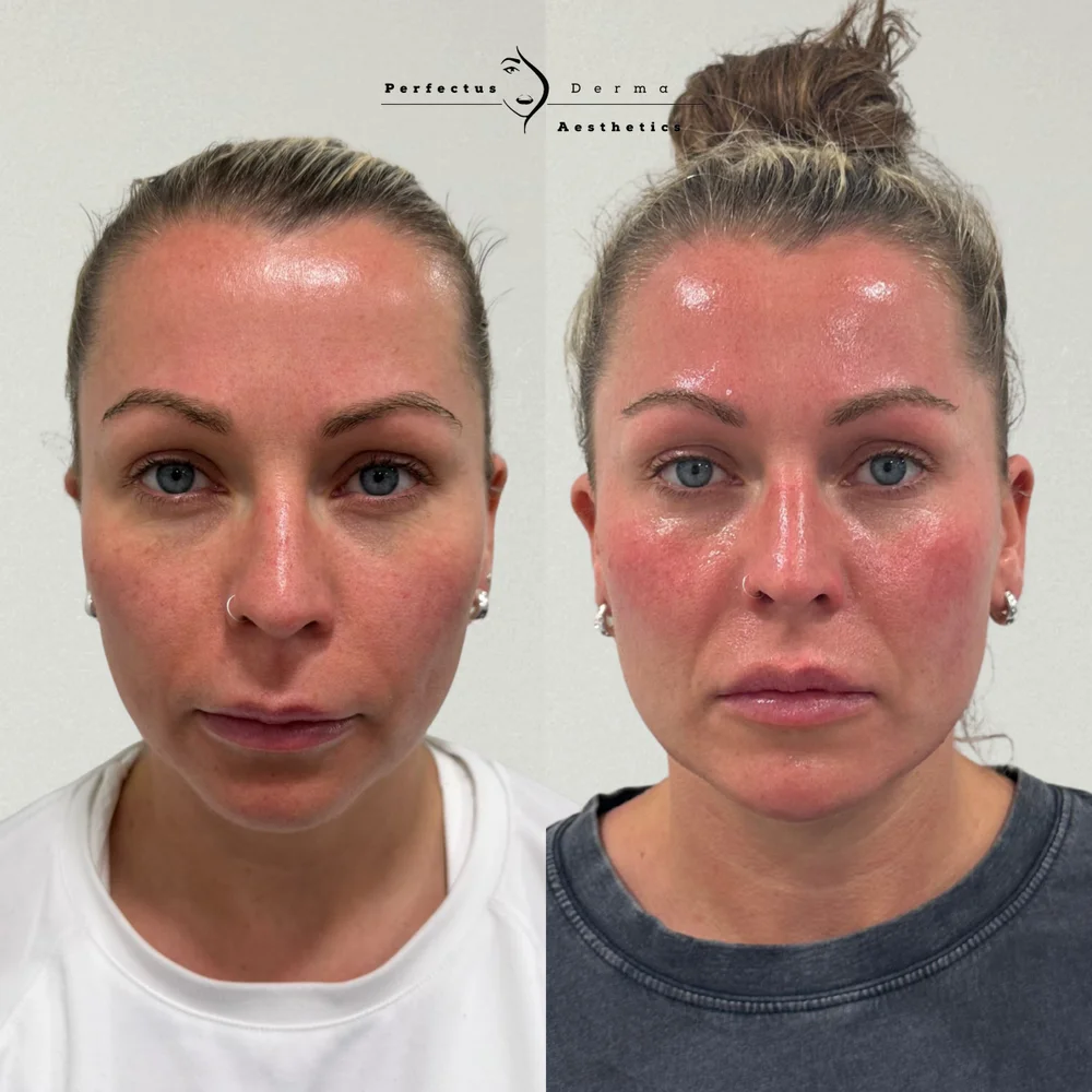Mid and lower face before and after dermal filler contouring at Perfectus Derma Aesthetics