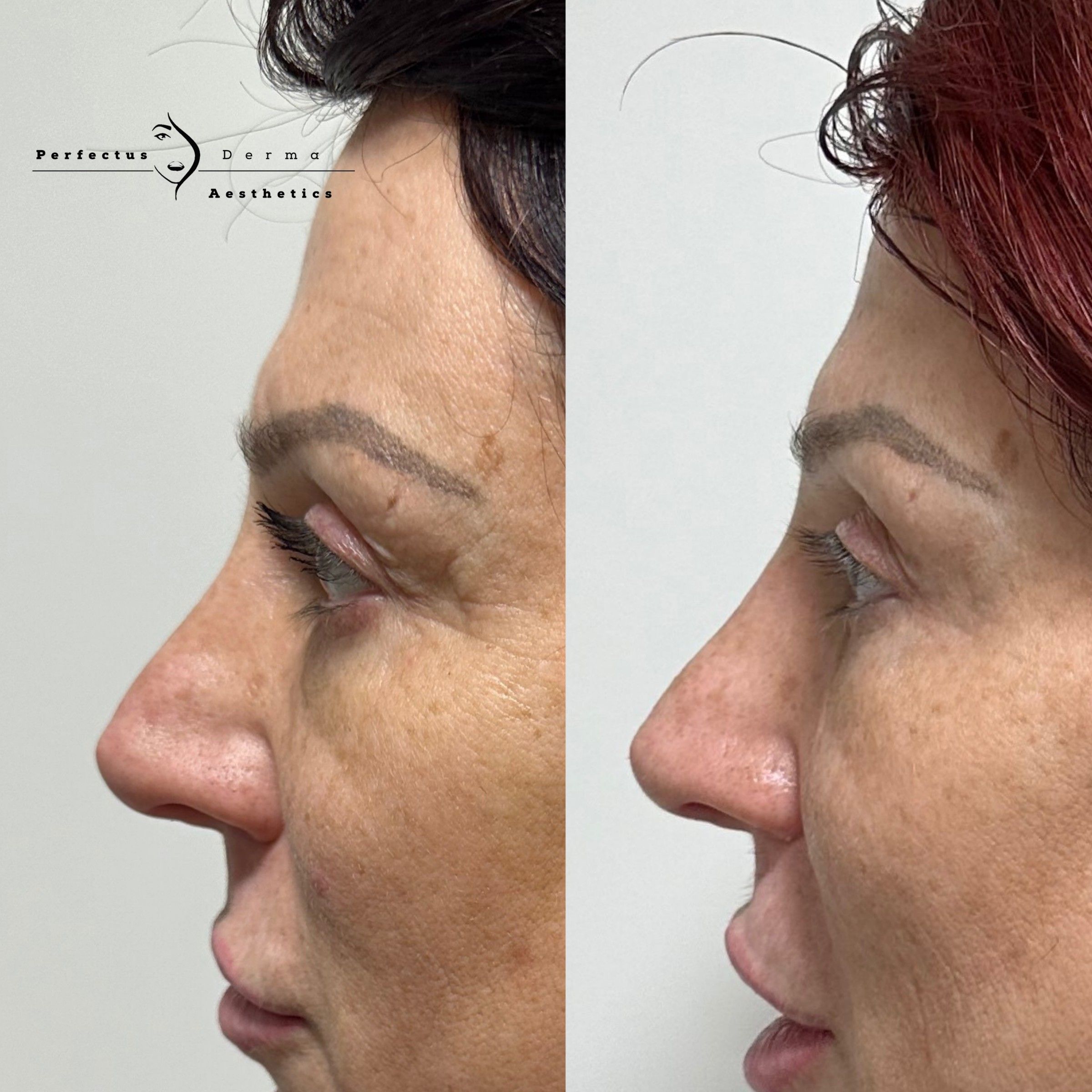 Profile view of the nose before and after non-surgical rhinoplasty at Perfectus Derma Aesthetics