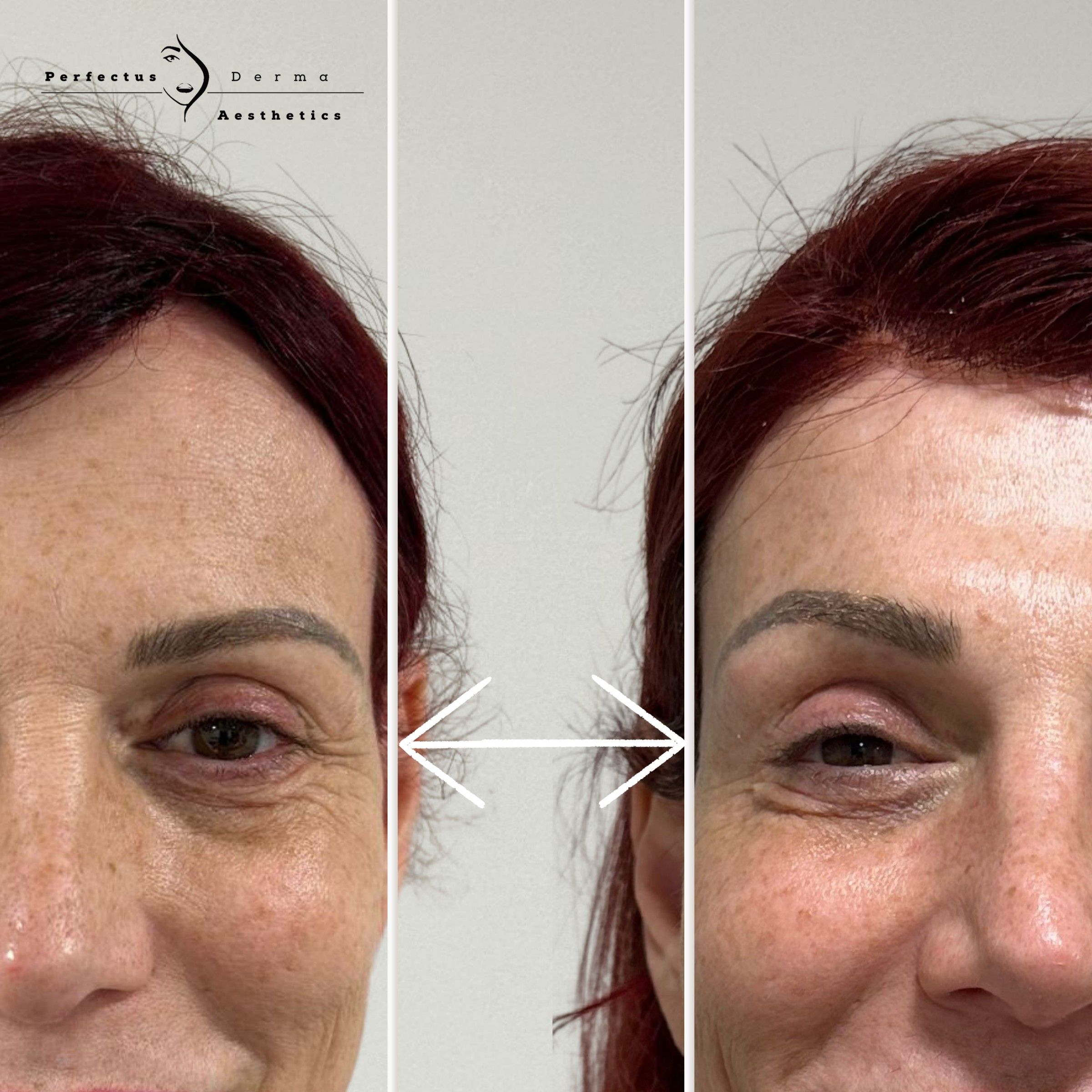 Temple area before and after dermal filler treatment at Perfectus Derma Aesthetics