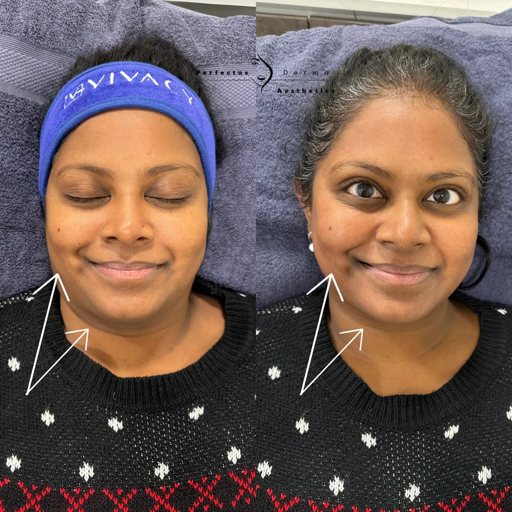 Skin radiance before and immediately after a Hydro2Facial at Perfectus Derma Aesthetics
