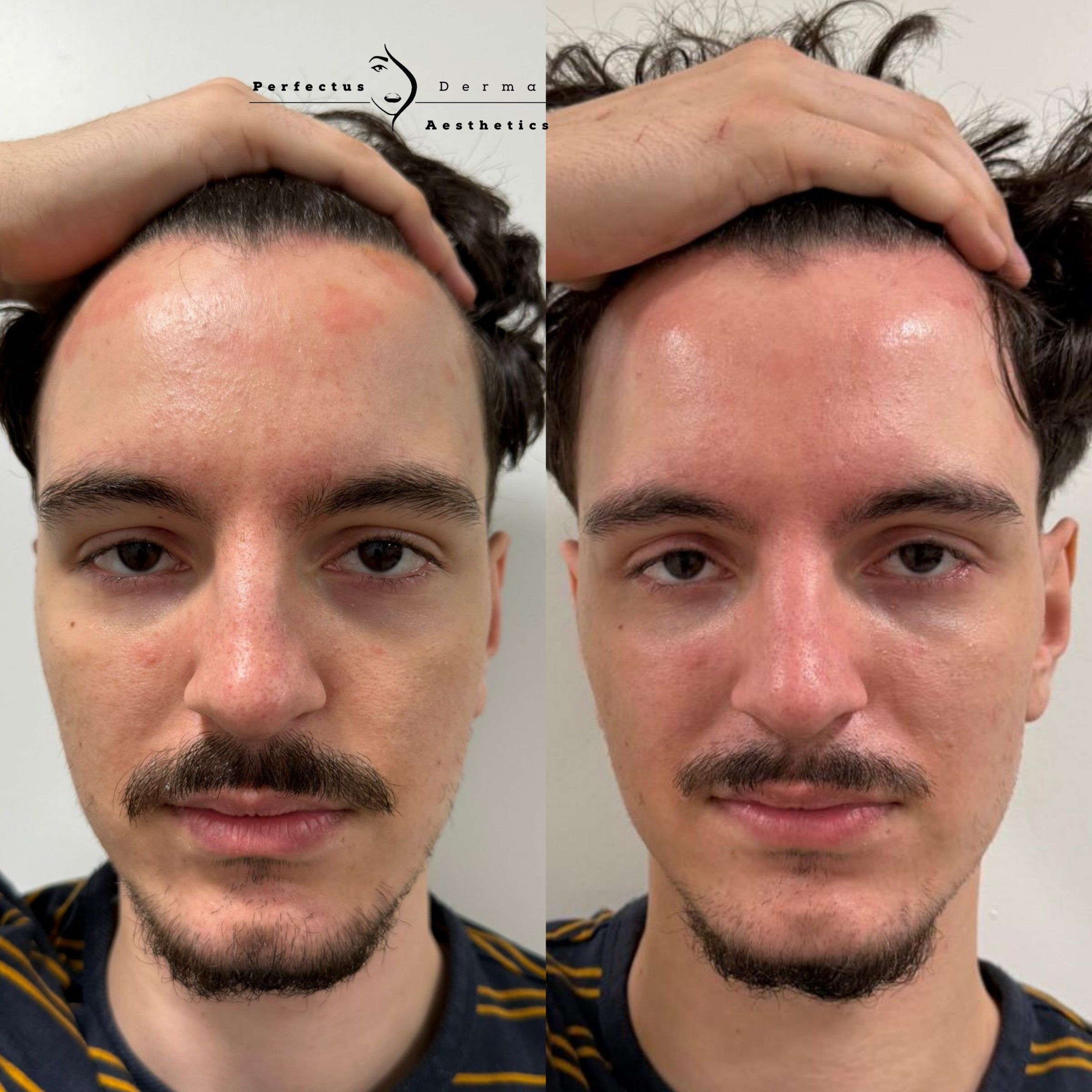 Forehead and face before and after ten LED phototherapy sessions for psoriasis-affected skin at Perfectus Derma Aesthetics