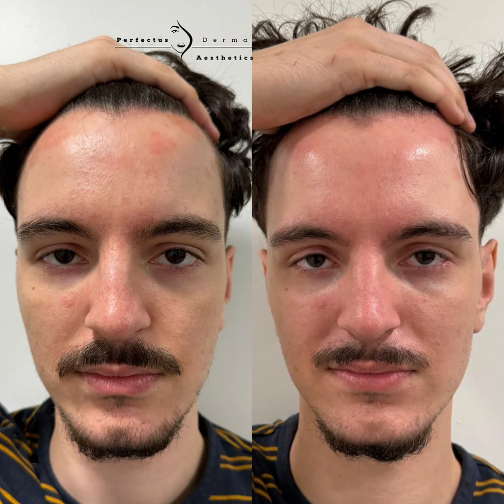Forehead and face before and after ten LED phototherapy sessions for psoriasis-affected skin at Perfectus Derma Aesthetics