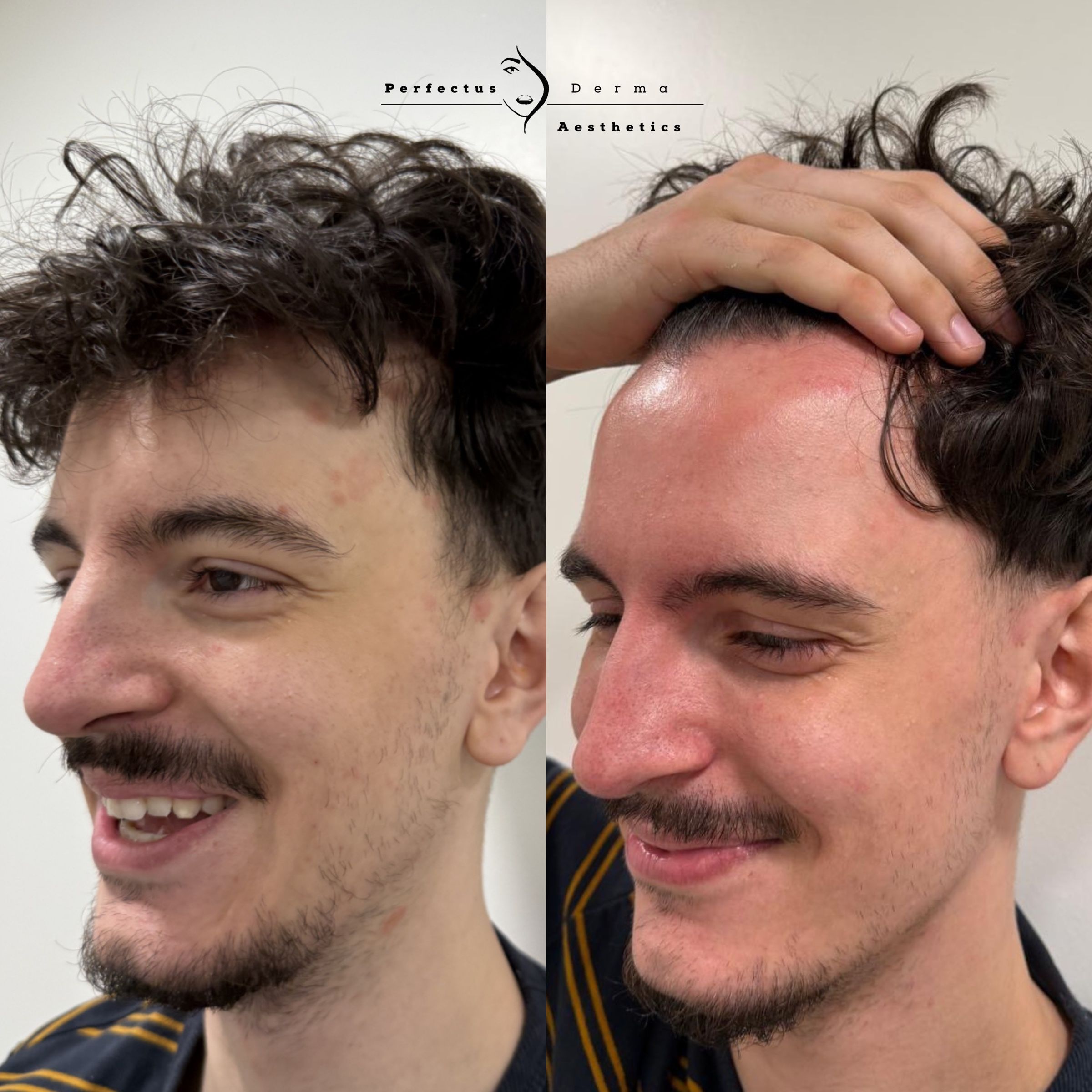 Three-quarter view of the temple and cheek before and after ten LED phototherapy sessions for psoriasis-affected skin at Perfectus Derma Aesthetics