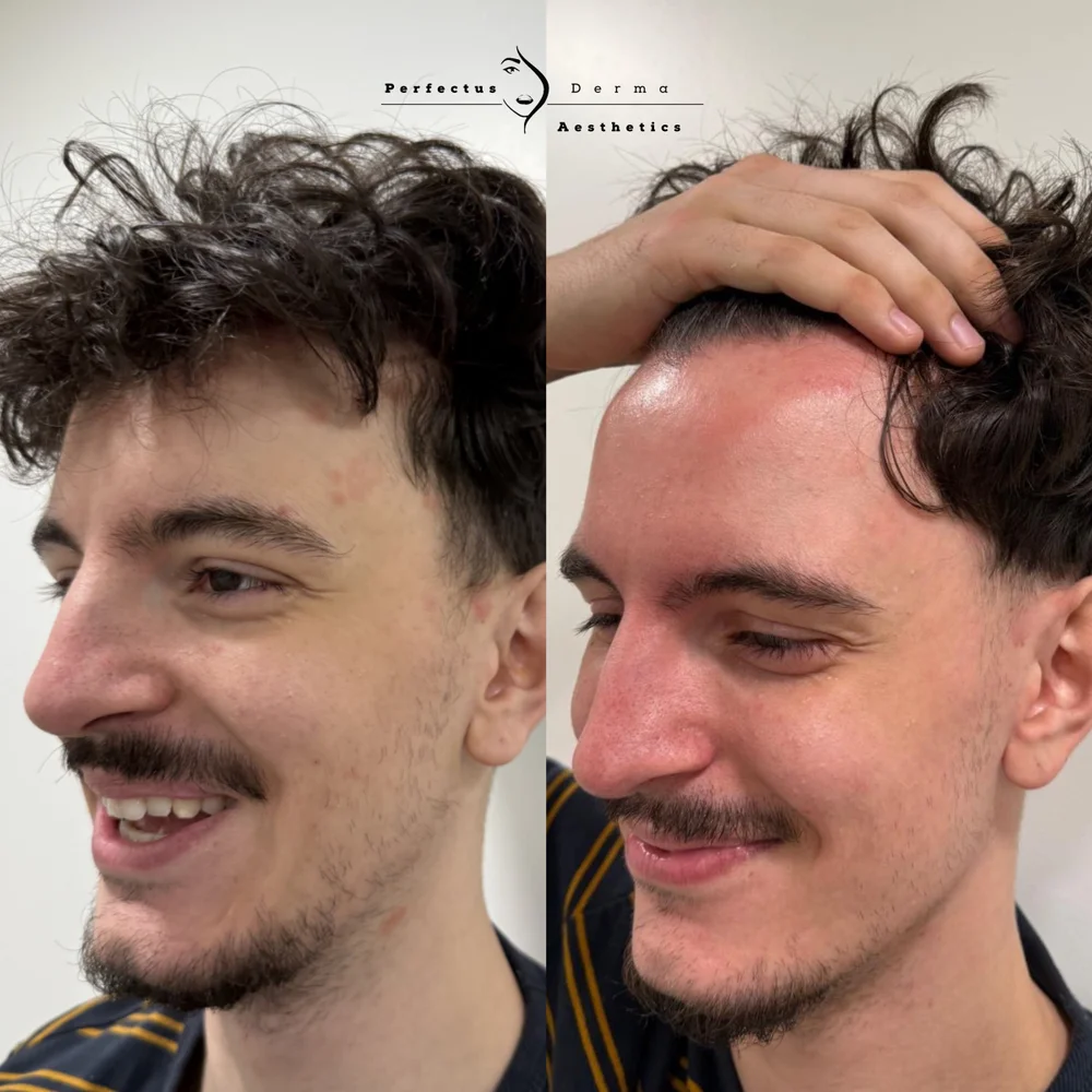 Three-quarter view of the temple and cheek before and after ten LED phototherapy sessions for psoriasis-affected skin at Perfectus Derma Aesthetics