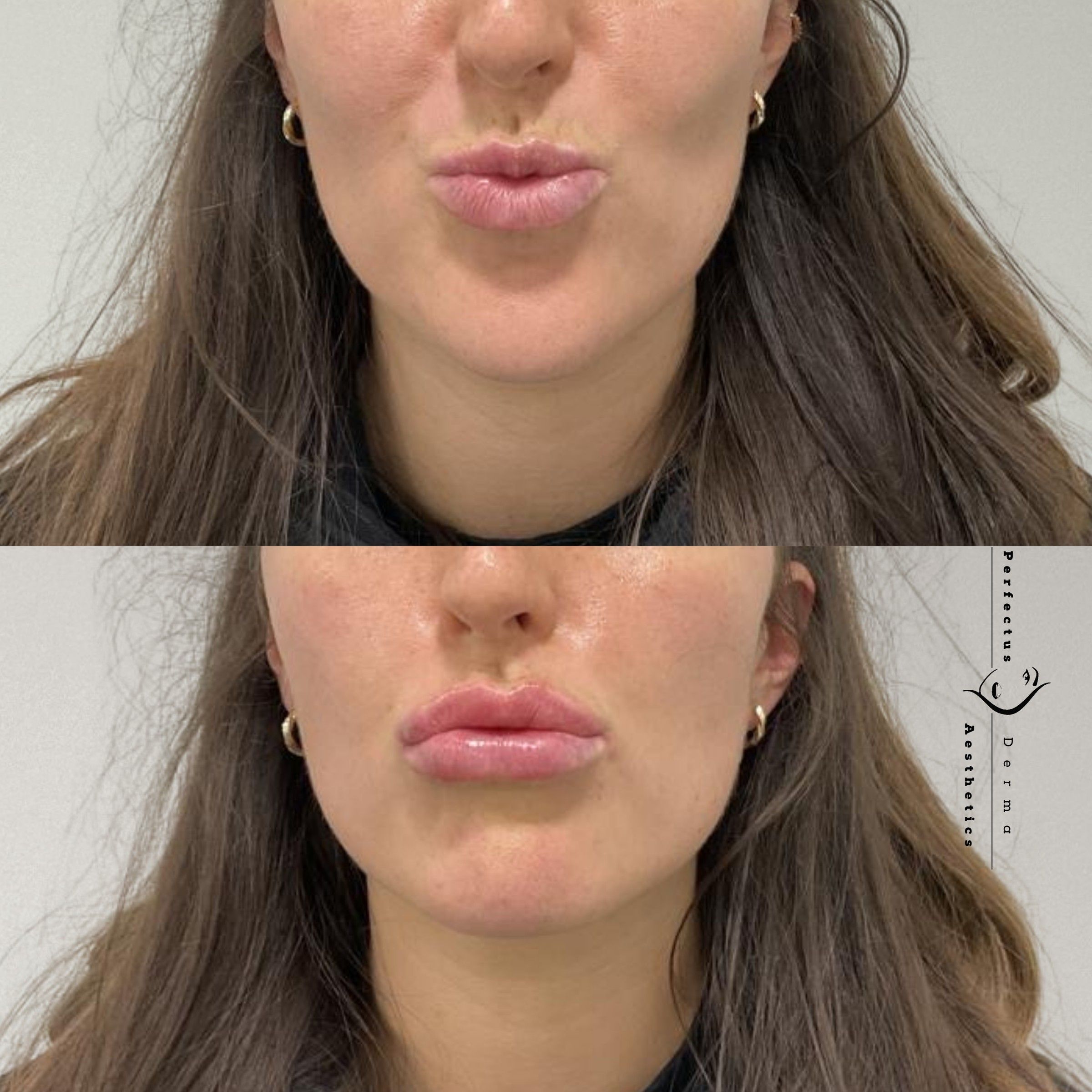 Close view of the lips before and after dermal filler treatment at Perfectus Derma Aesthetics