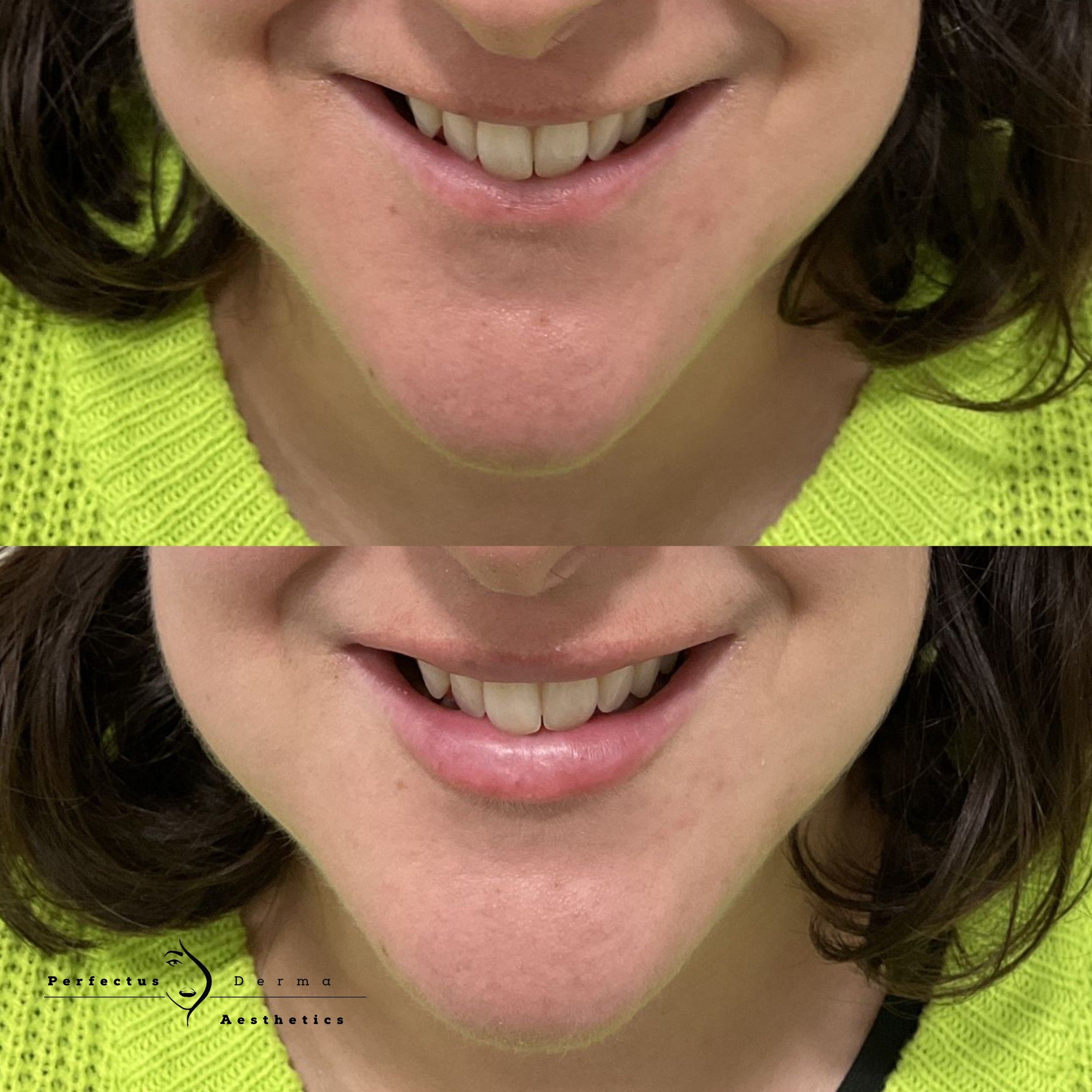 Lips before and after dermal filler treatment at Perfectus Derma Aesthetics