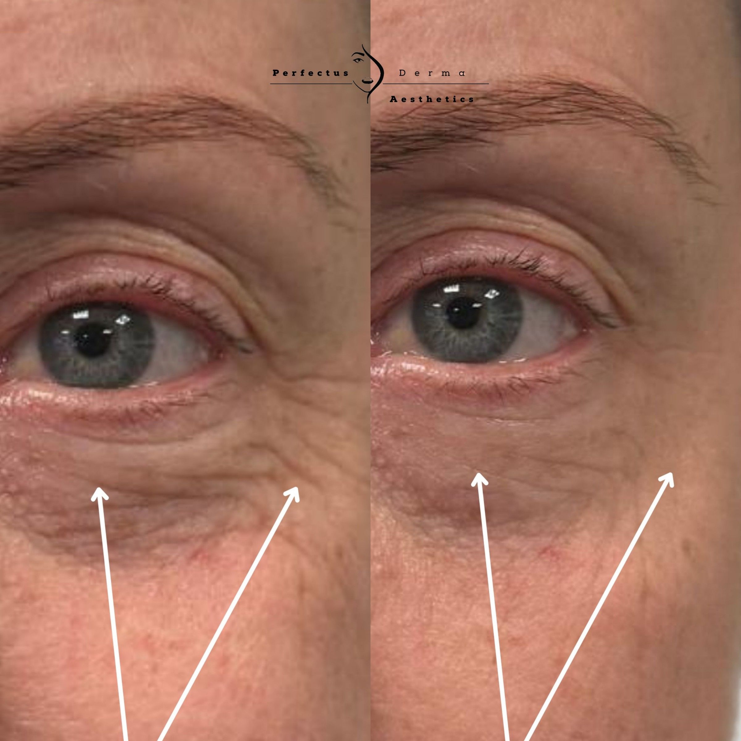 Eye area and fine lines before and after a course of polynucleotide treatment at Perfectus Derma Aesthetics