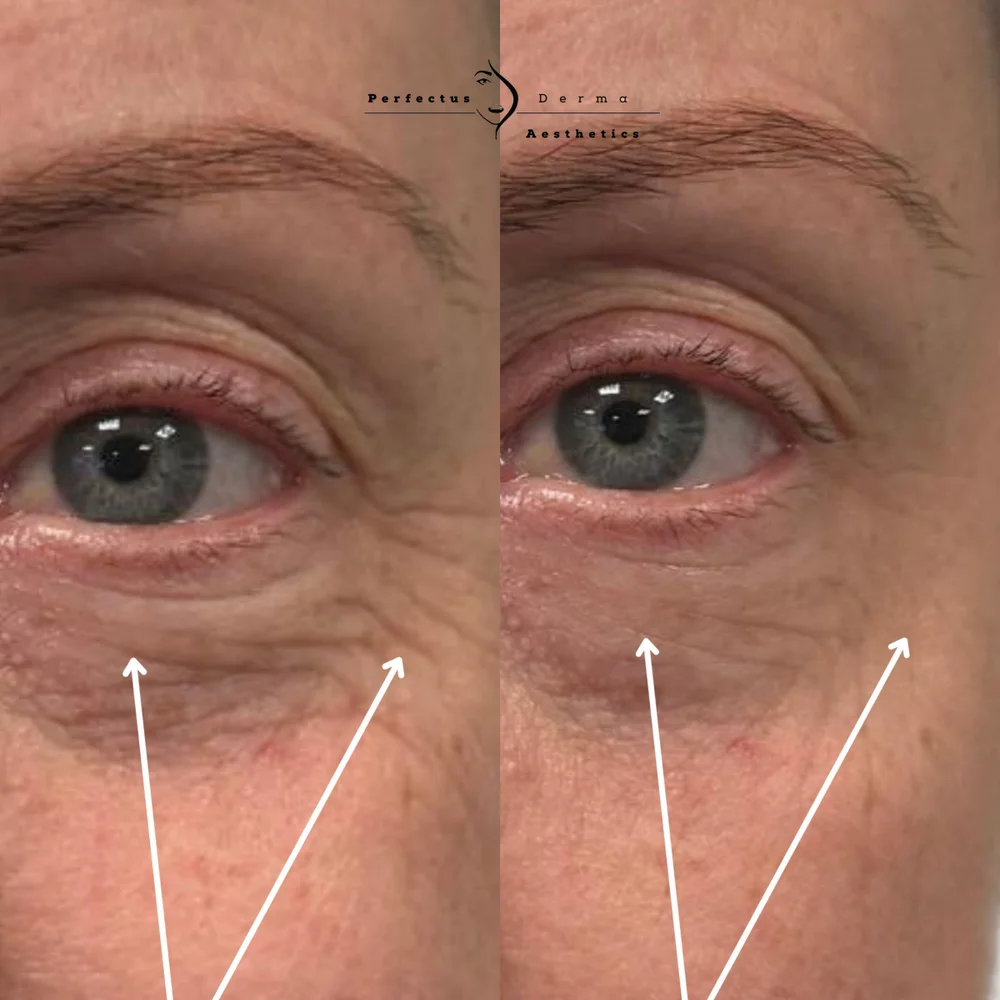 Eye area and fine lines before and after a course of polynucleotide treatment at Perfectus Derma Aesthetics