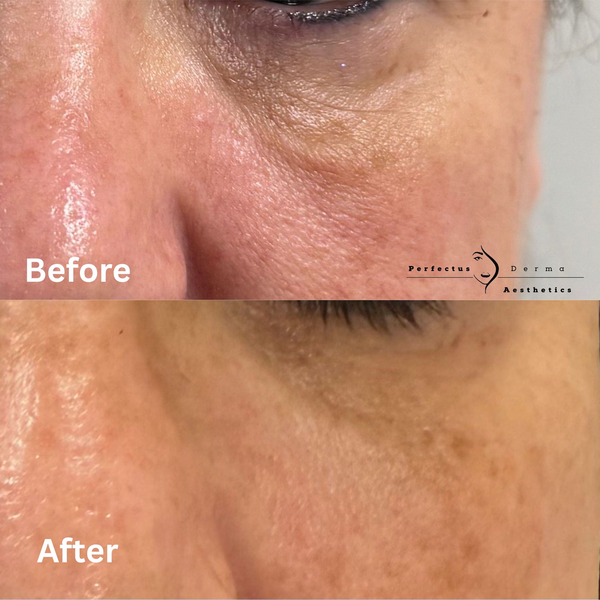 Under-eye area before and after a course of polynucleotide treatment at Perfectus Derma Aesthetics