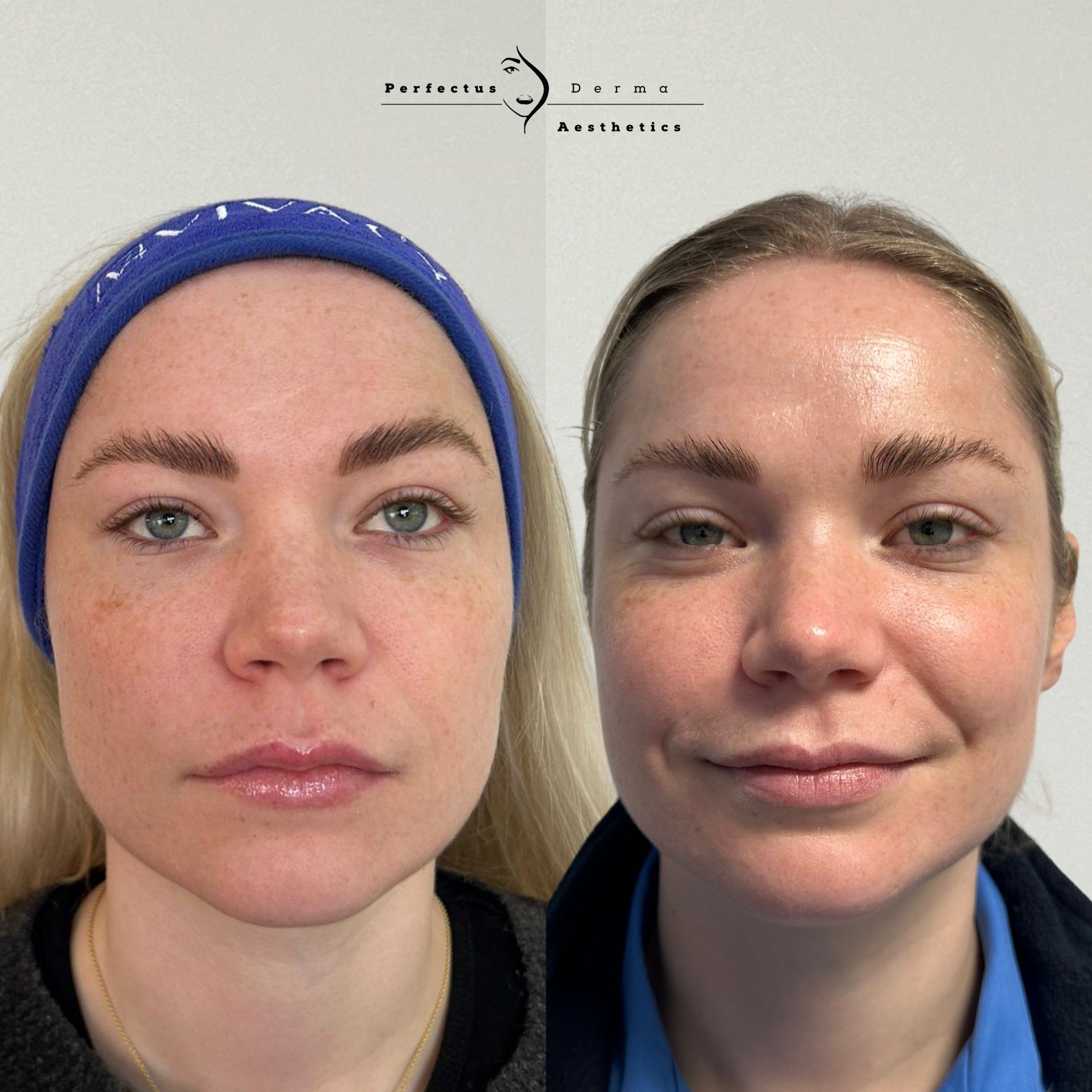 Facial skin before and after a course of skin booster treatment at Perfectus Derma Aesthetics