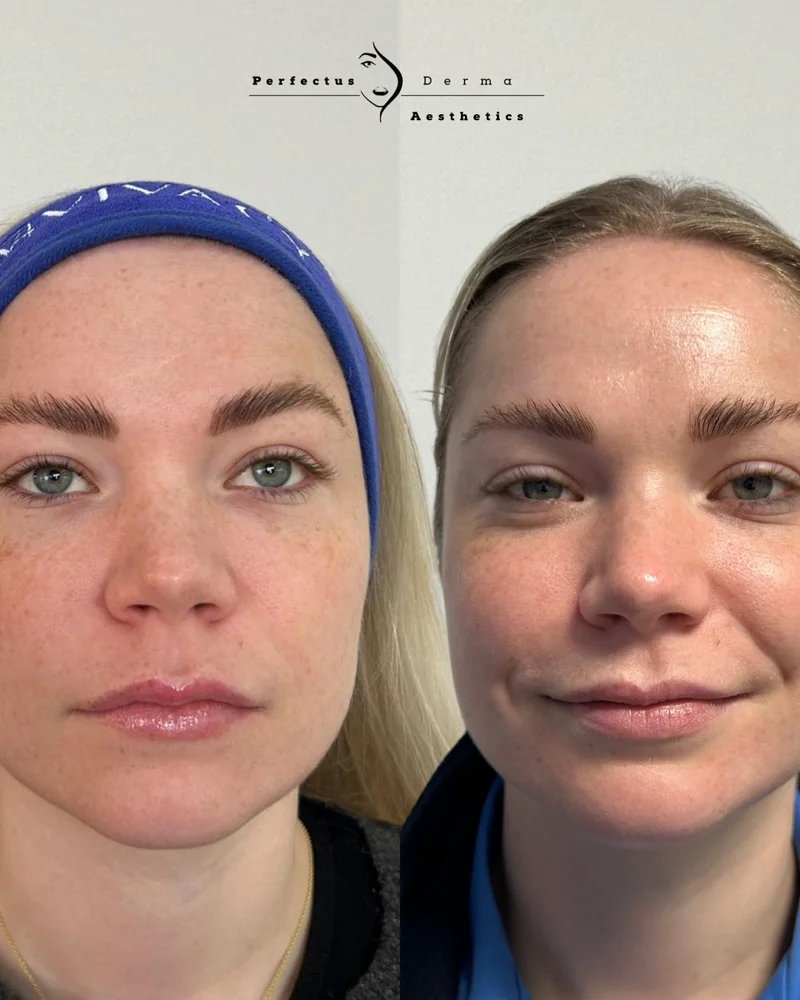 Skin boosters: hydration and skin quality