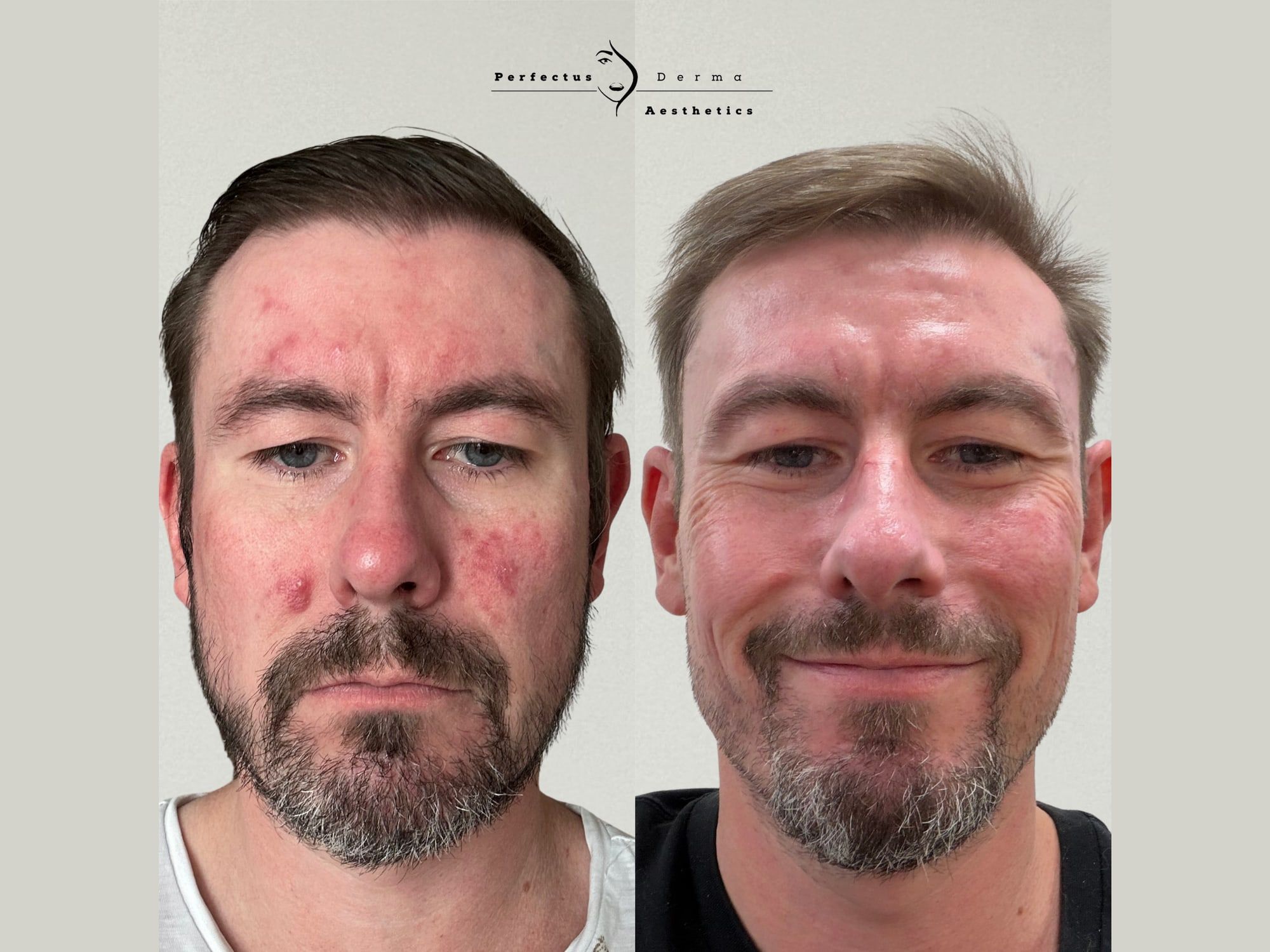 Facial redness and inflammatory spots before, and calmer, more even skin after, at Perfectus Derma Aesthetics