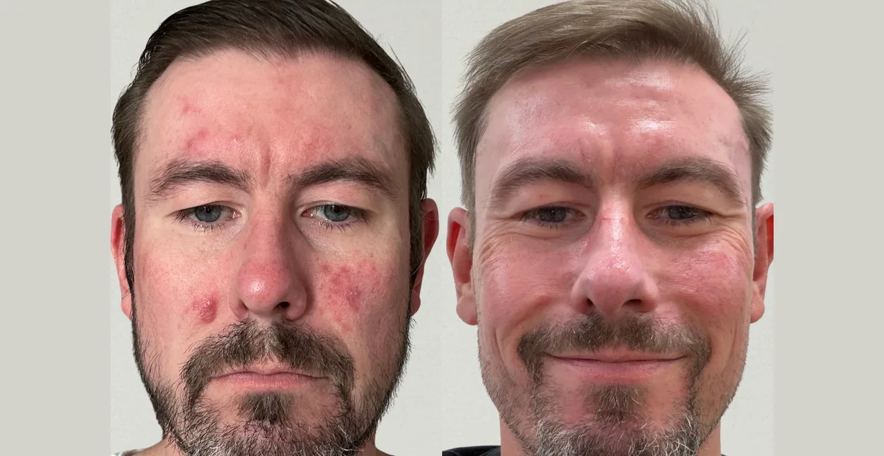 Facial redness and inflammatory spots before, and calmer, more even skin after, at Perfectus Derma Aesthetics