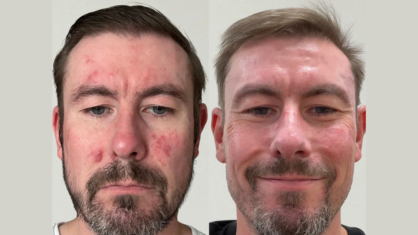 Facial redness and inflammatory spots before, and calmer, more even skin after, at Perfectus Derma Aesthetics