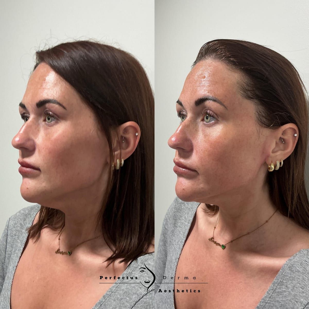 Dermal Fillers