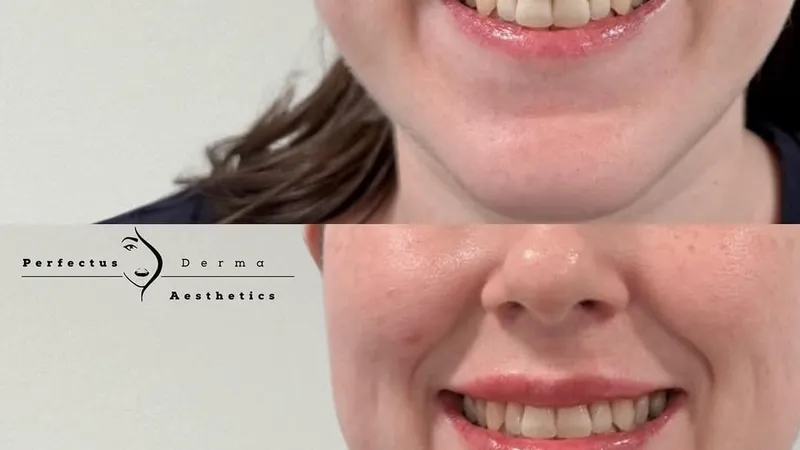 Lip filler treatment with an NMC-registered nurse at Perfectus Derma, Soho